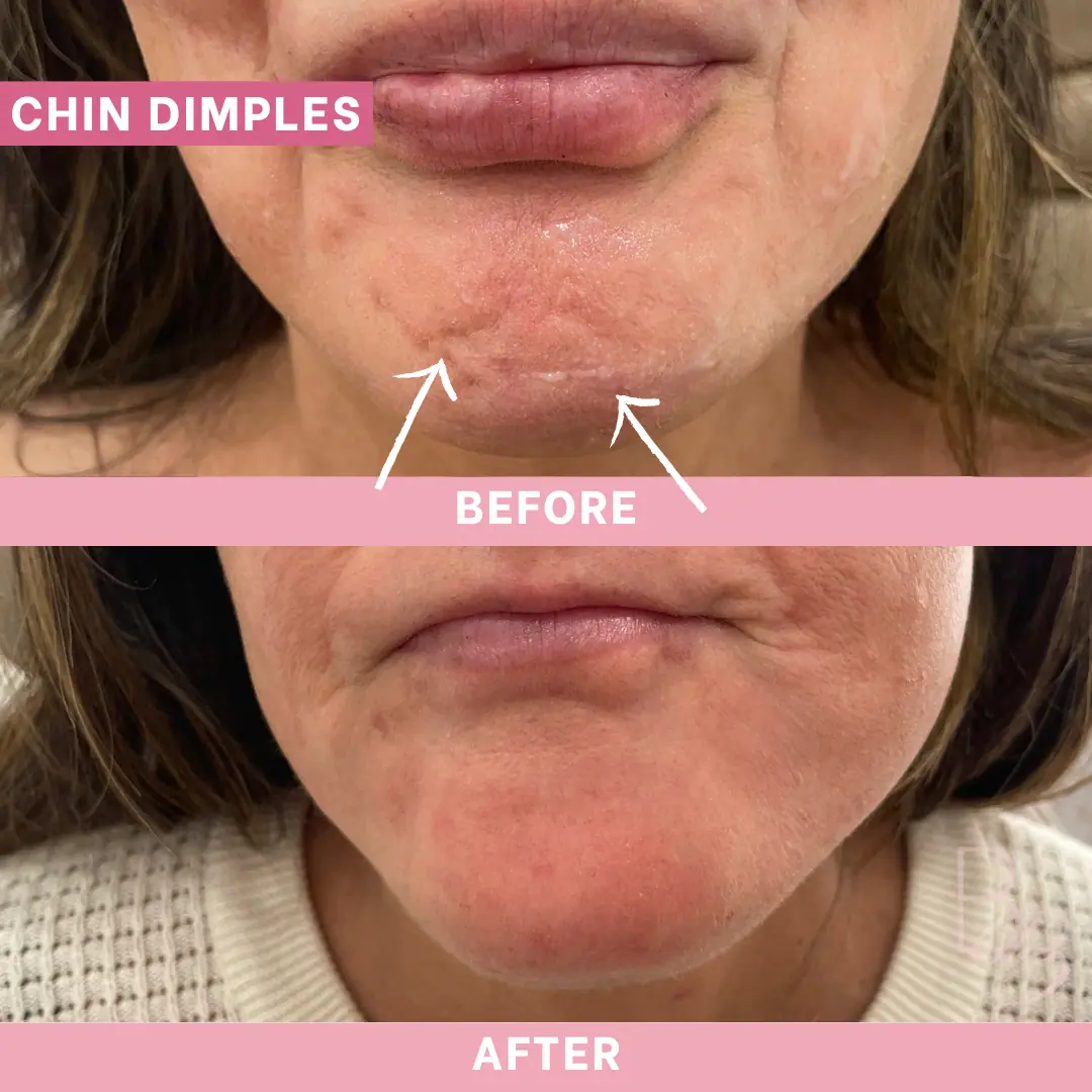 Before and After Chin Dimples | Beauty Boost Med Spa in Newport Beach, CA