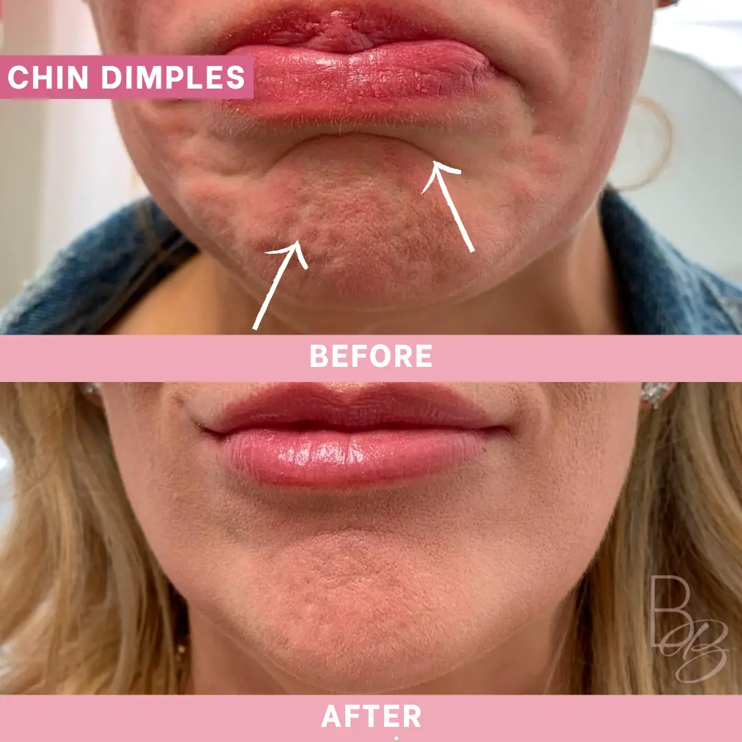 Before and After Chin Dimples | Beauty Boost Med Spa in Newport Beach, CA