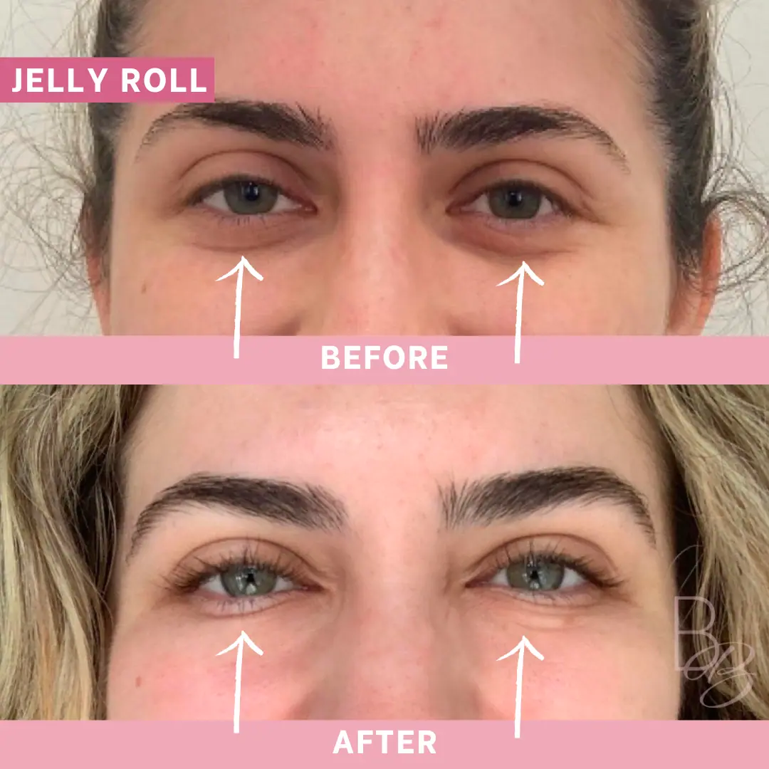 Before and After Jelly Roll | Beauty Boost Med Spa in Newport Beach, CA