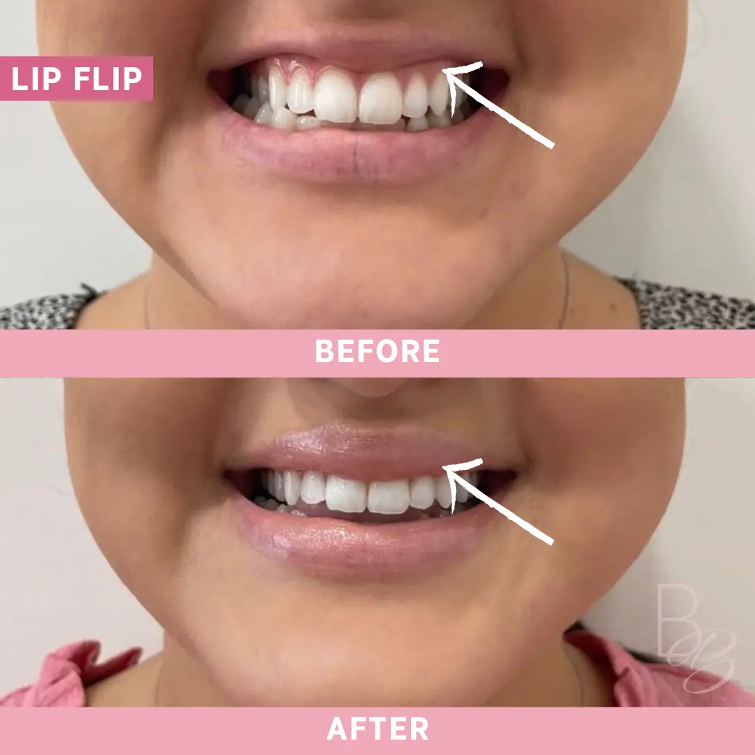 Before and After Lip Flip | Beauty Boost Med Spa in Newport Beach, CA