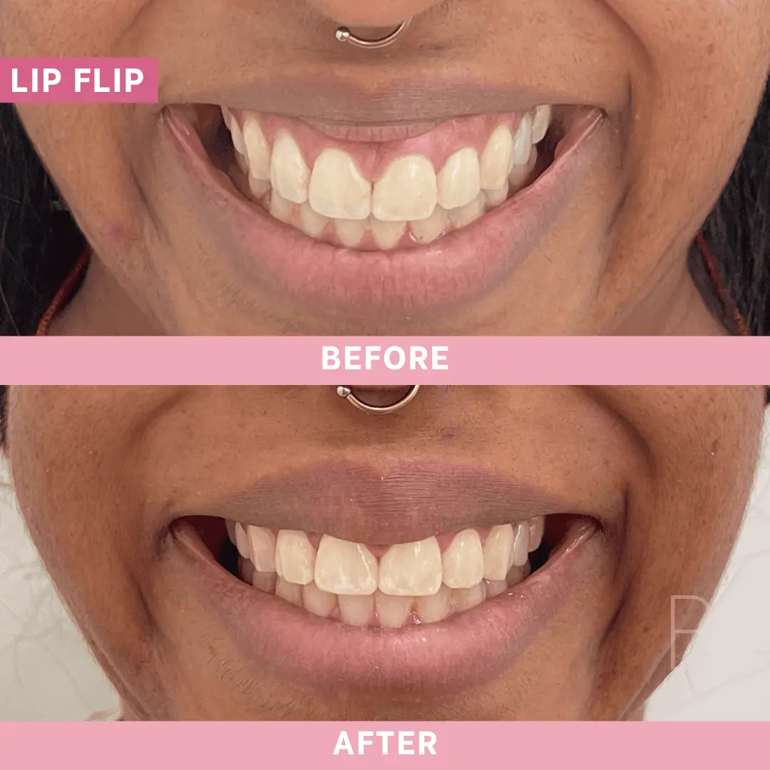 Before and After Lip Flip | Beauty Boost Med Spa in Newport Beach, CA