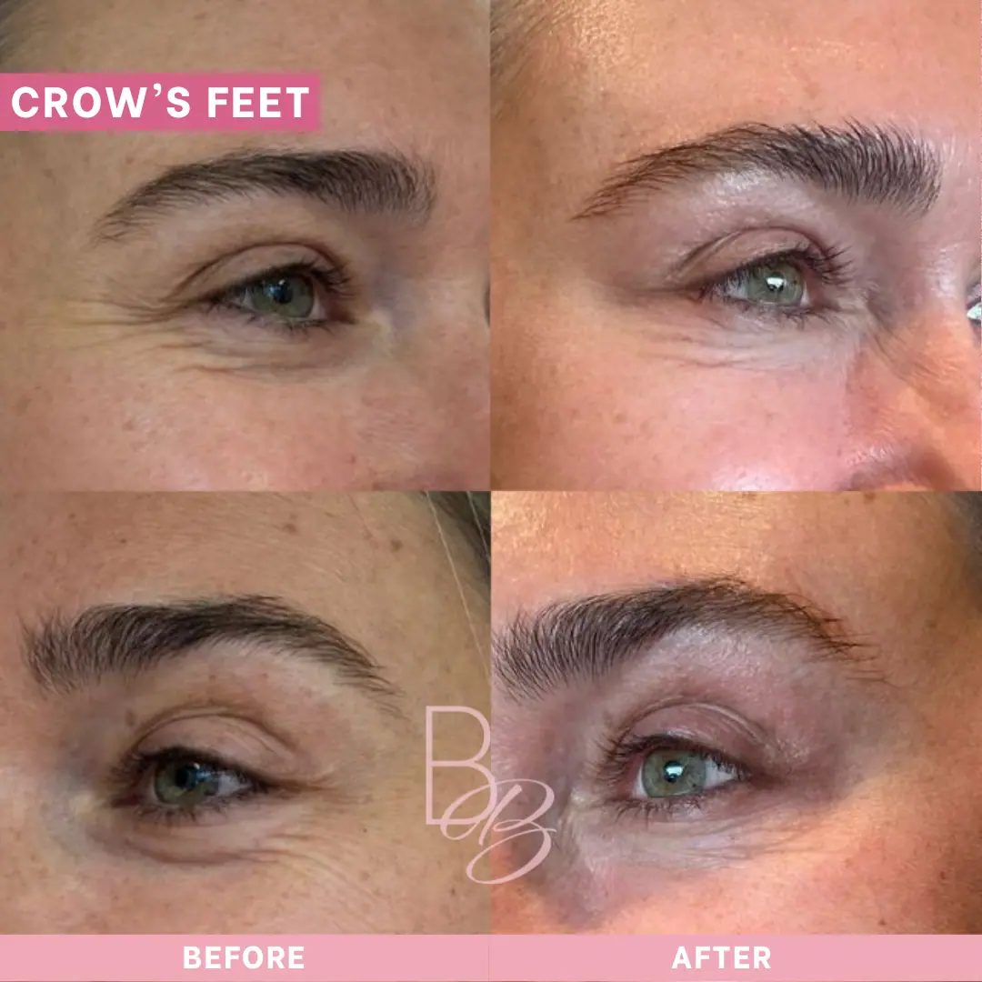 Before and After Crow's Feet | Beauty Boost Med Spa in Newport Beach, CA