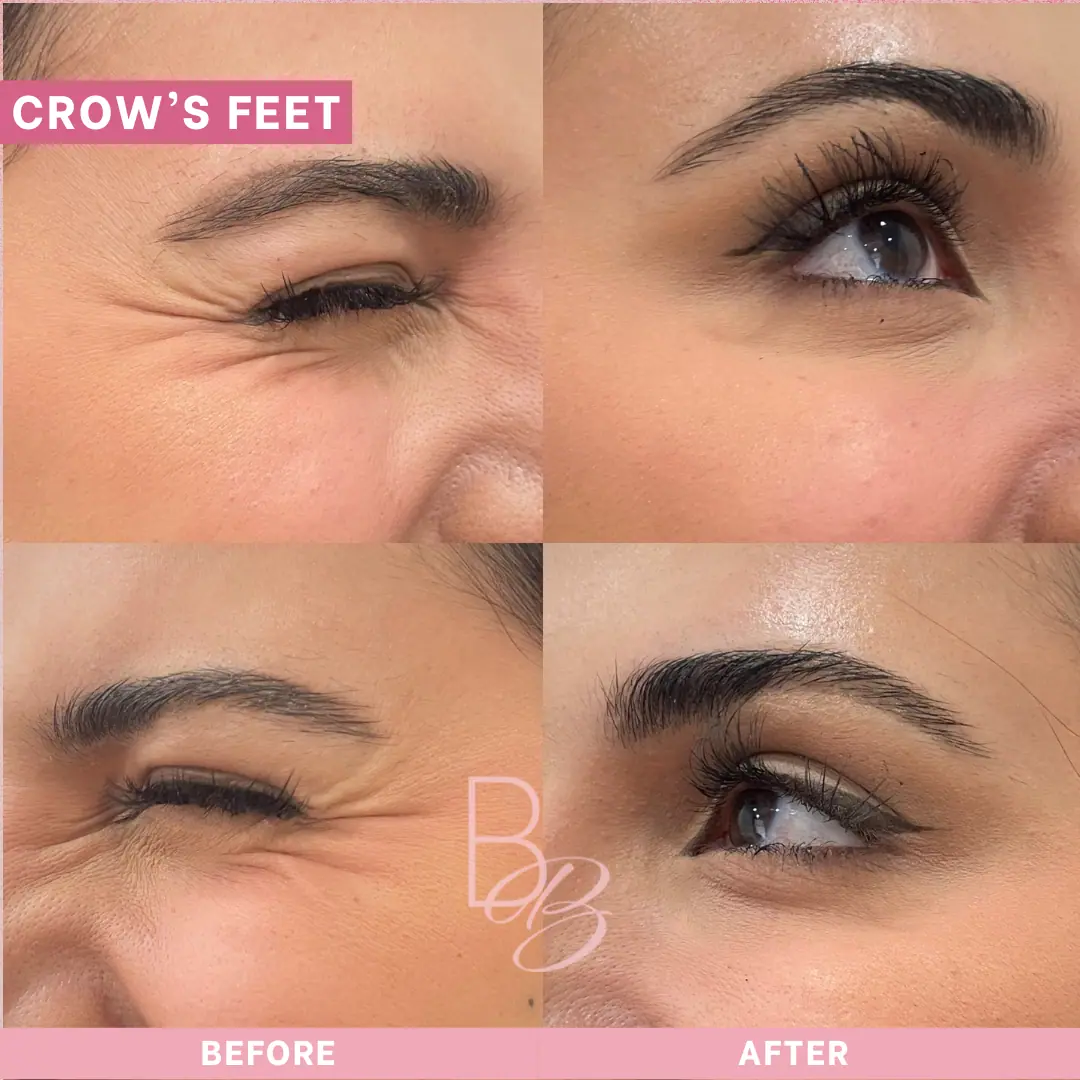 Before and After Crow's Feet | Beauty Boost Med Spa in Newport Beach, CA