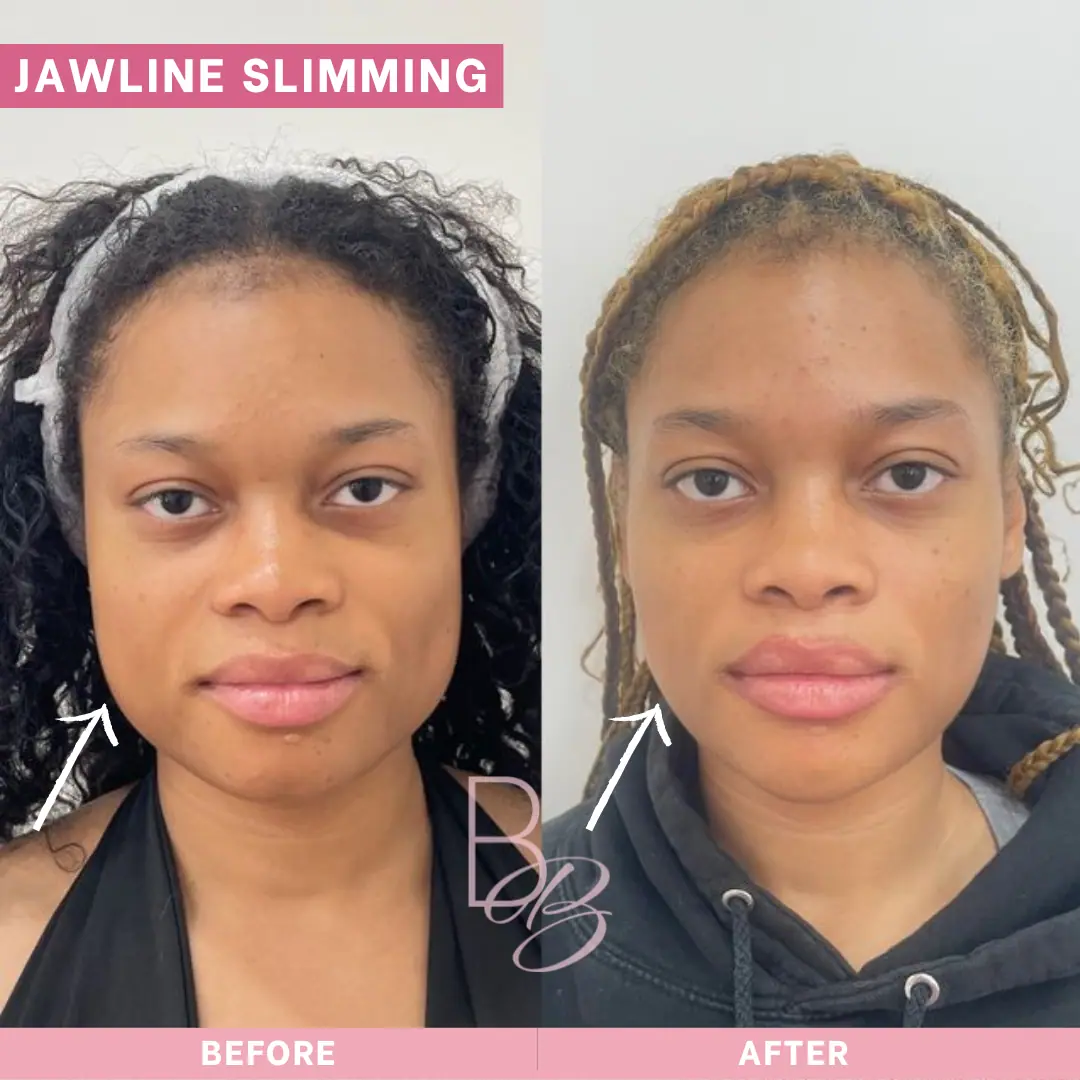 Before and After Jawline Slimming | Beauty Boost Med Spa in Newport Beach, CA