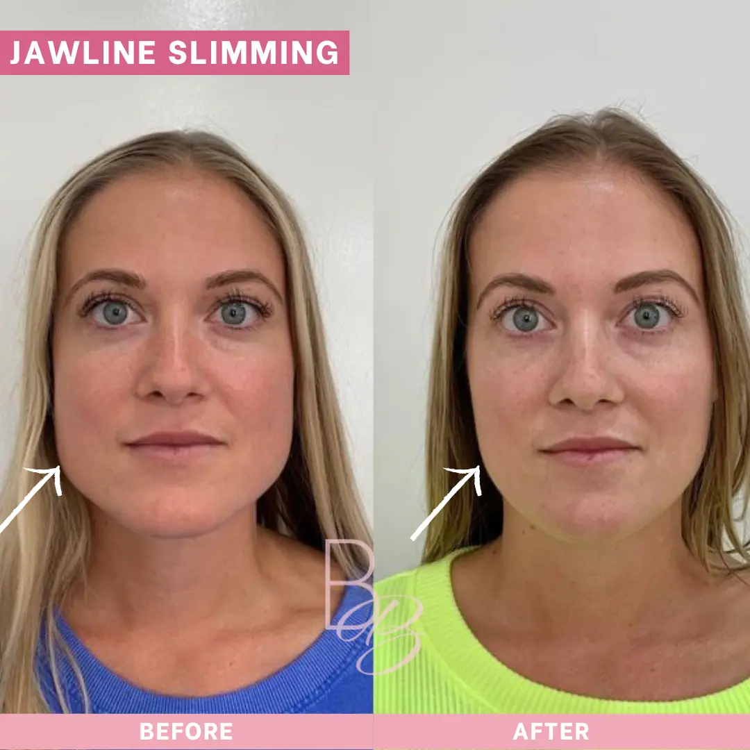 Before and After Jawline Slimming | Beauty Boost Med Spa in Newport Beach, CA