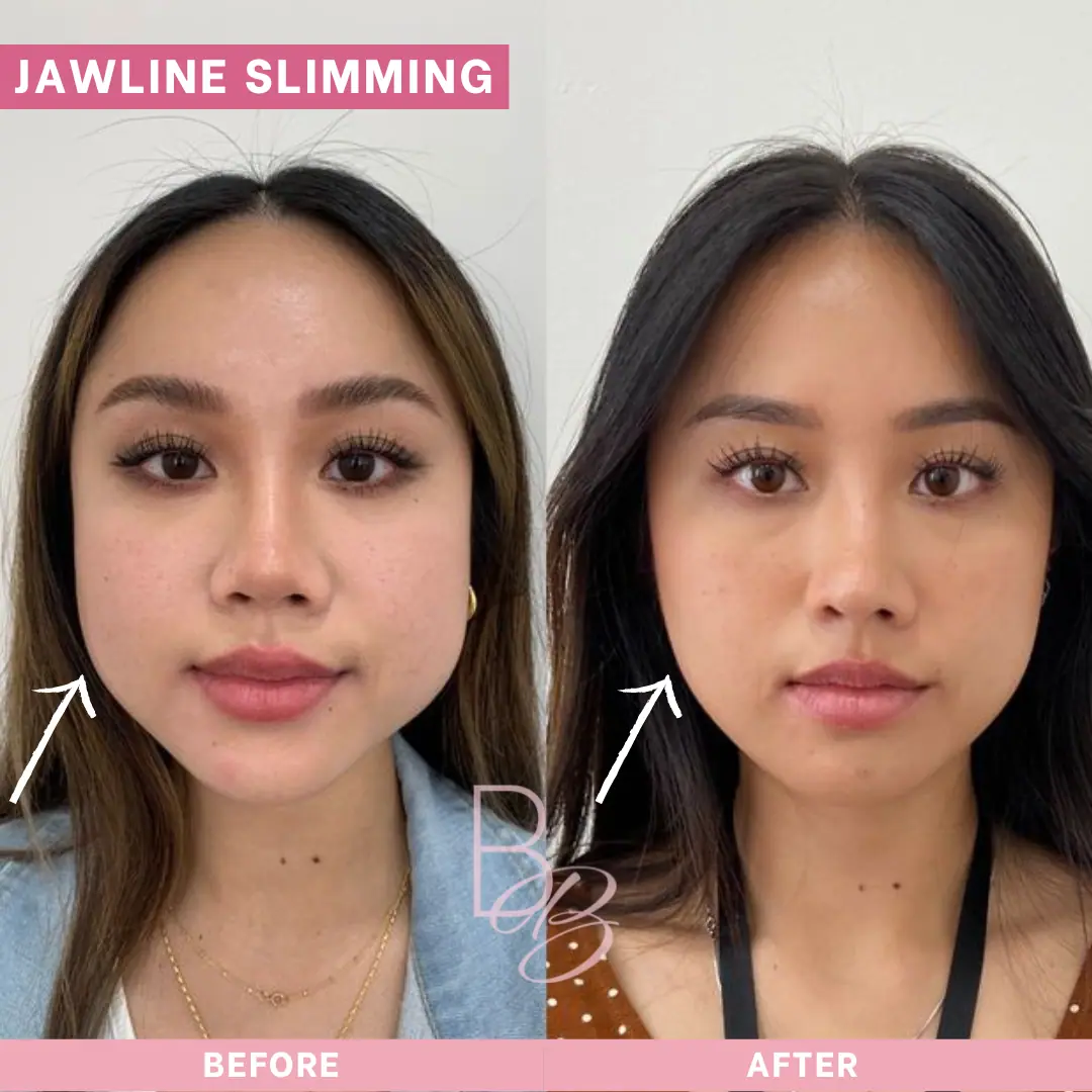 Before and After Jawline Slimming | Beauty Boost Med Spa in Newport Beach, CA