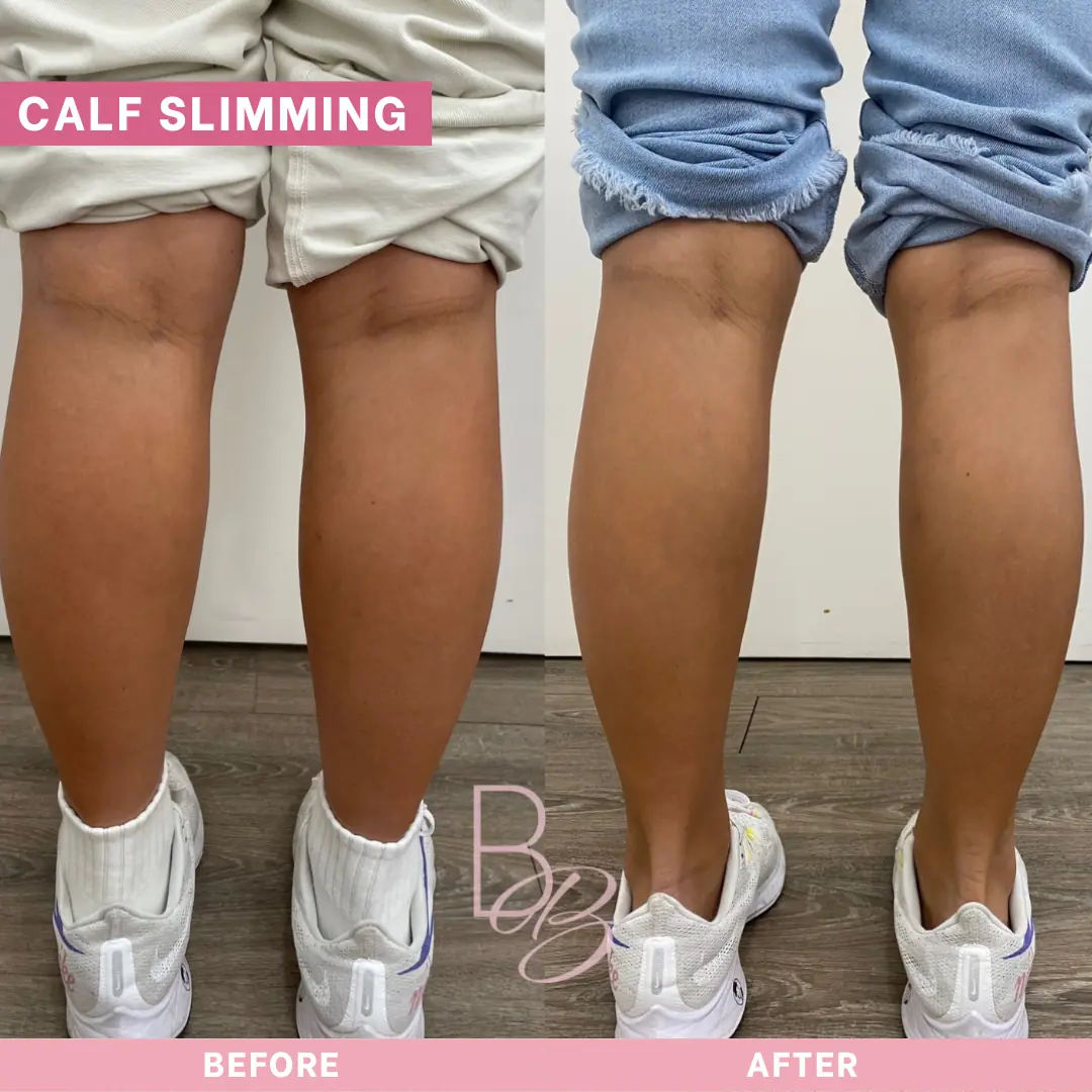 Before and After Calf Slimming | Beauty Boost Med Spa in Newport Beach, CA