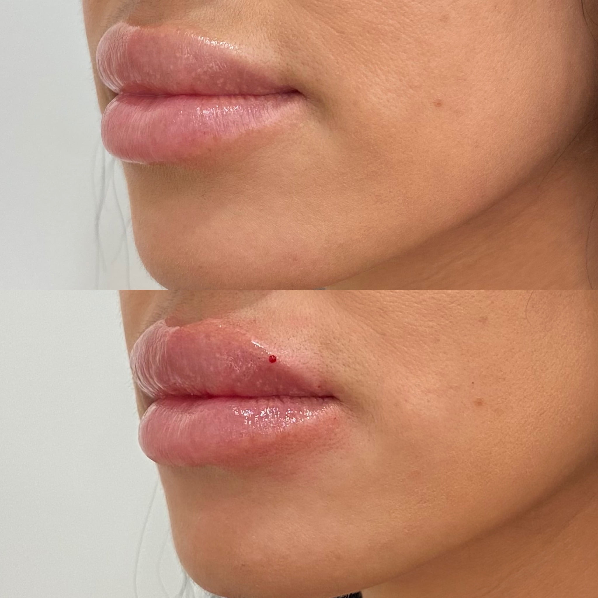 Before and After Fillers Lip line treatment | Beauty Boost Med Spa at Newport Beach, CA