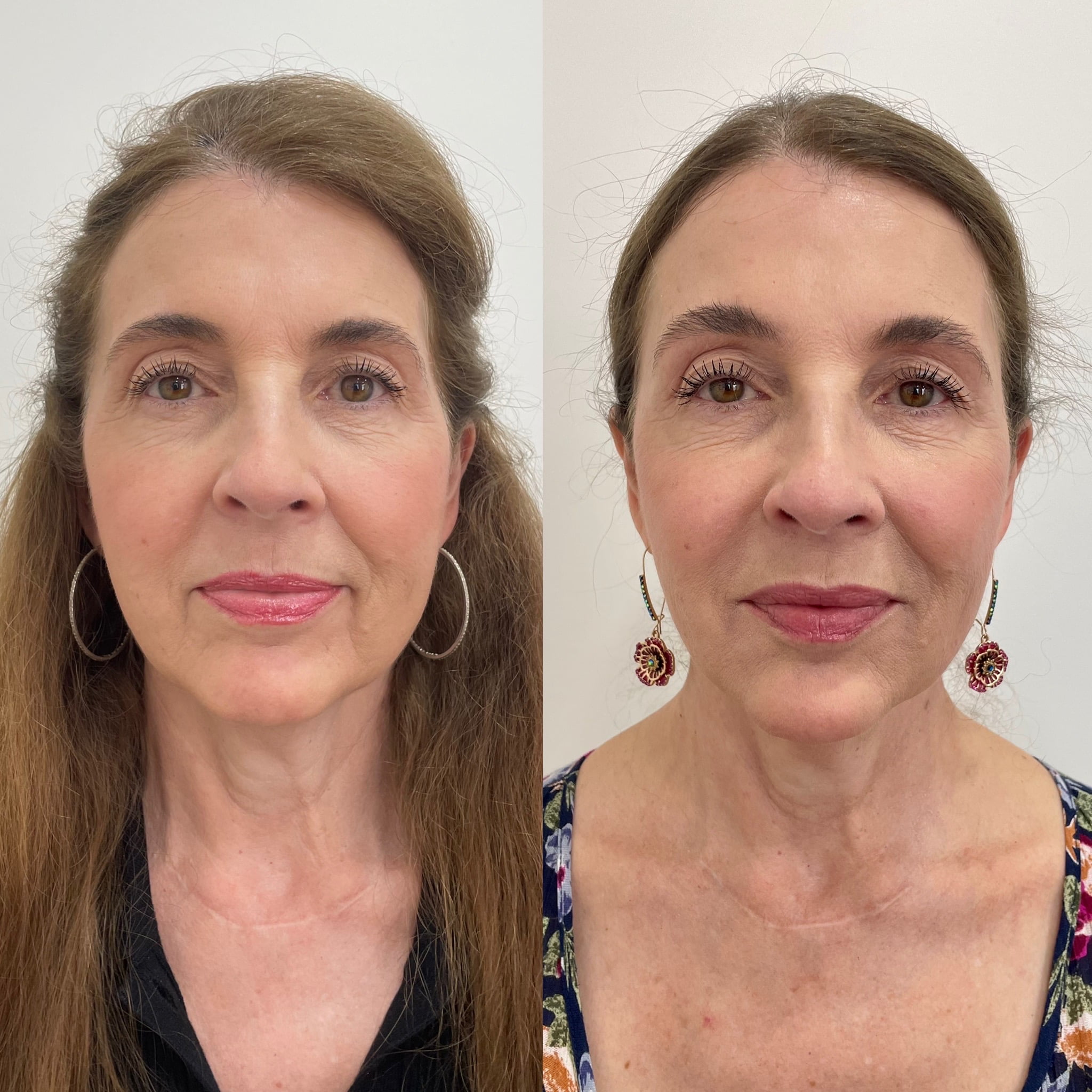 Before and After Fillers Marionettes treatment | Beauty Boost Med Spa at Newport Beach, CA