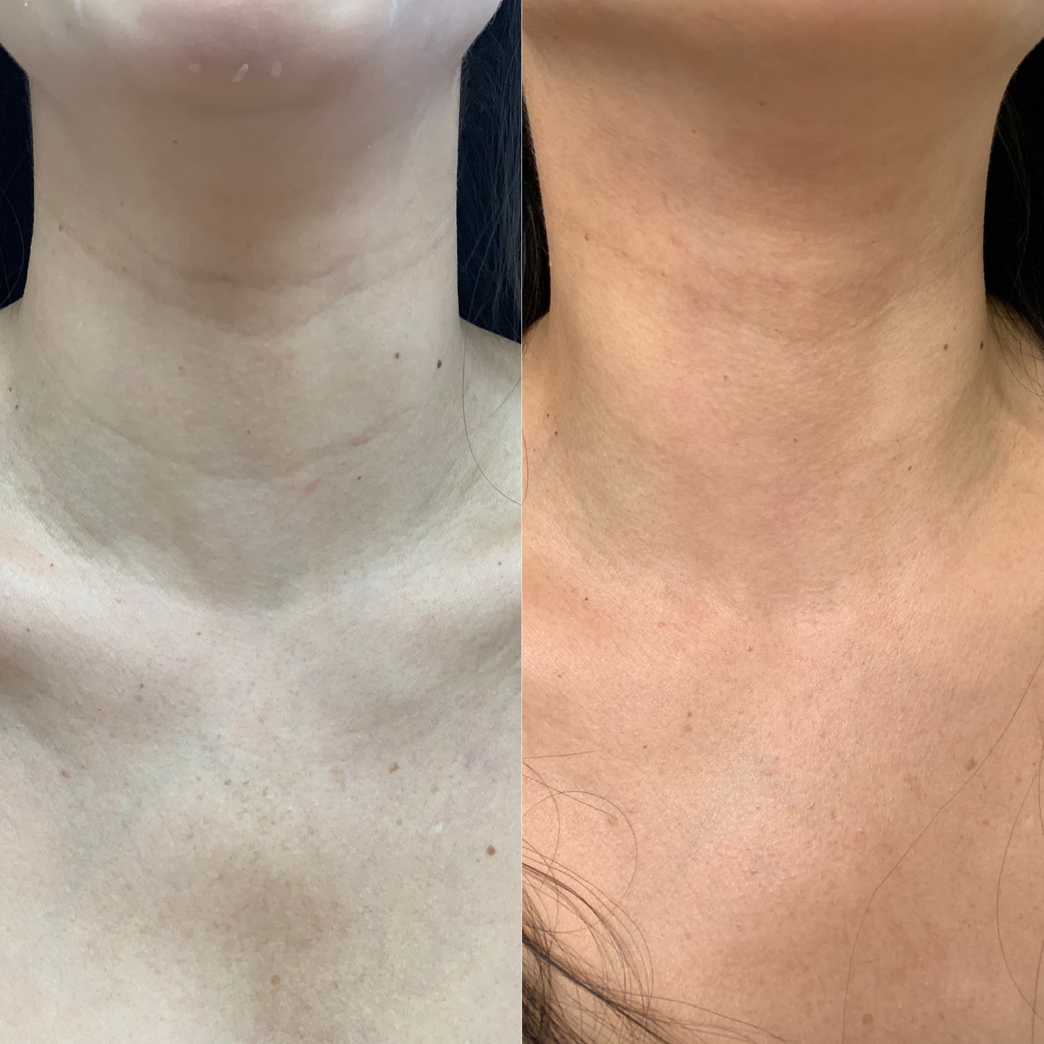 Before and After Fillers Neck Lines treatment | Beauty Boost Med Spa at Newport Beach, CA