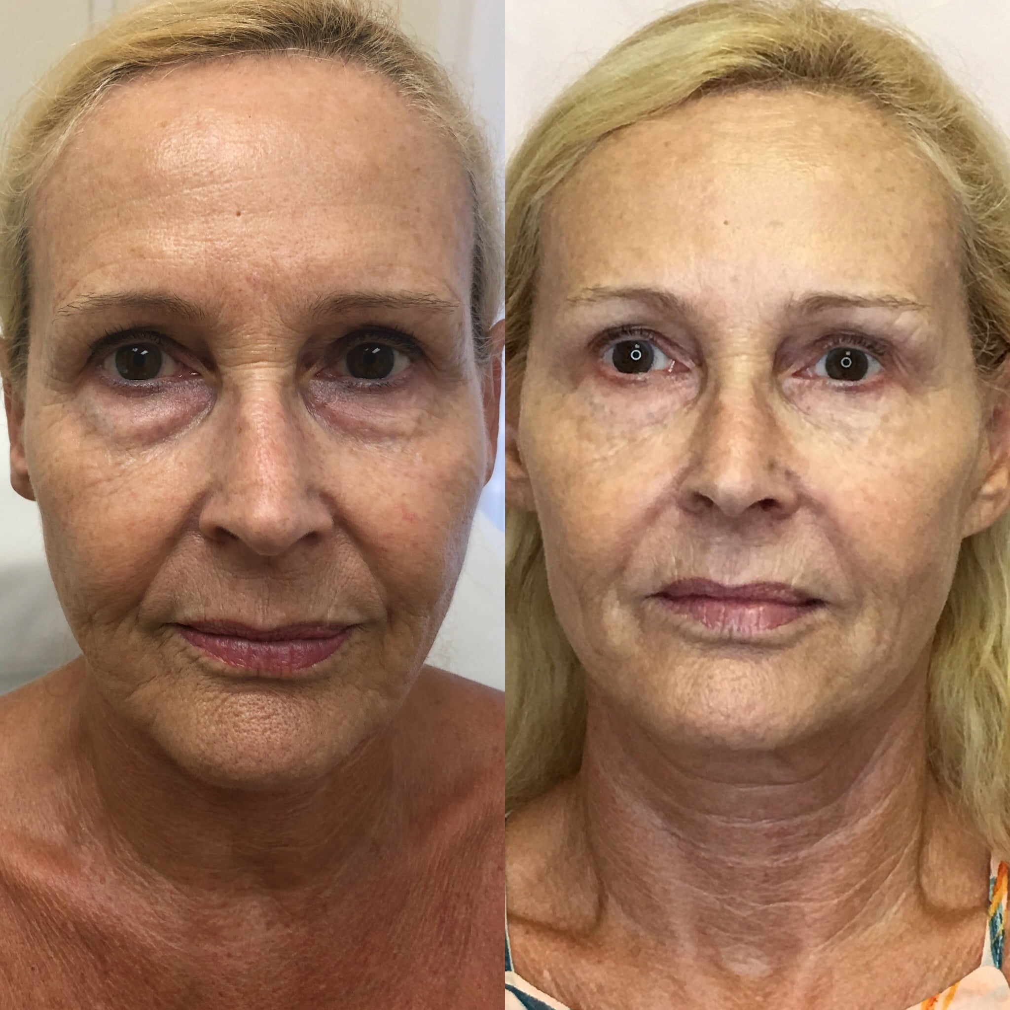Before and After Fillers Panfacial treatment | Beauty Boost Med Spa at Newport Beach, CA