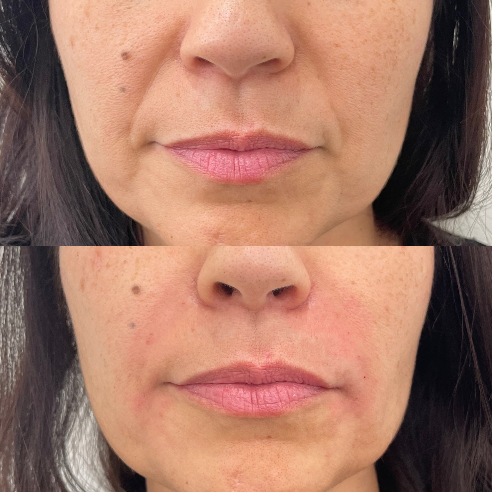Before and After Fillers Smile lines treatment | Beauty Boost Med Spa at Newport Beach, CA