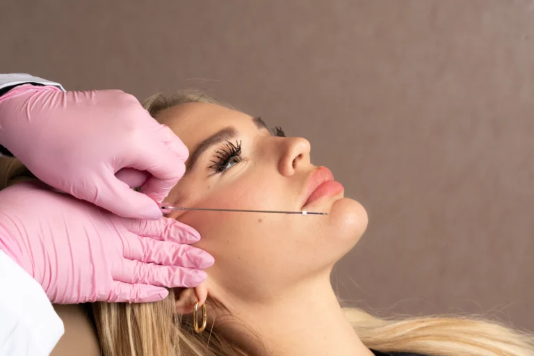 PDO Thread Lift in Newport Beach, CA | Beauty Boost Med Spa