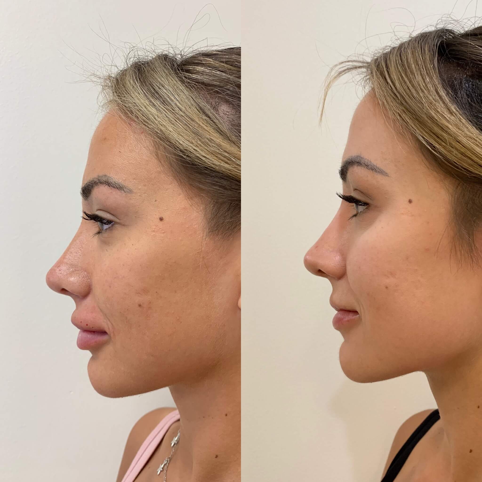 Before and After Three step Peel Treatment | Beauty Boost Med Spa in Newport Beach, CA