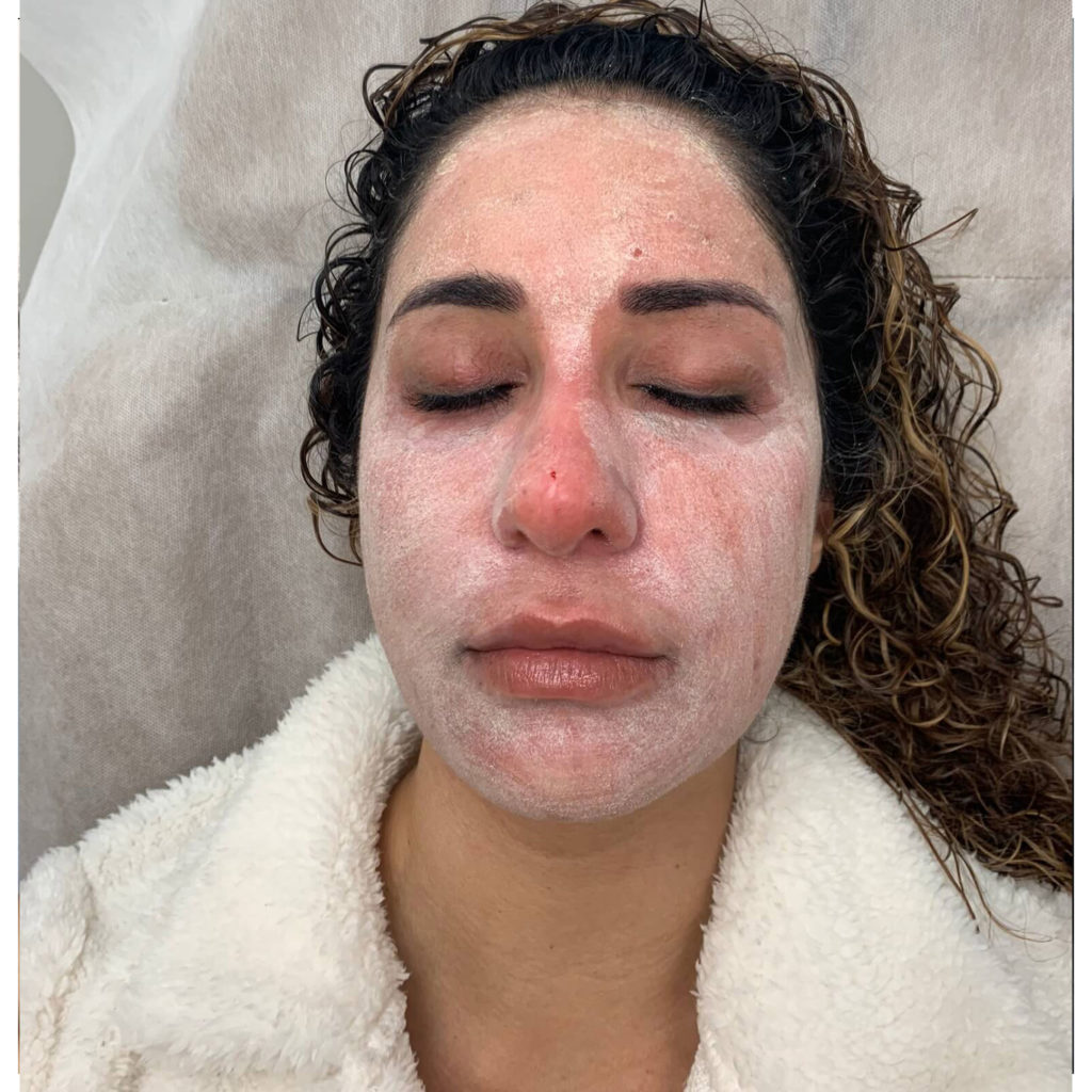 Before and After Three step Peel Treatment | Beauty Boost Med Spa in Newport Beach, CA