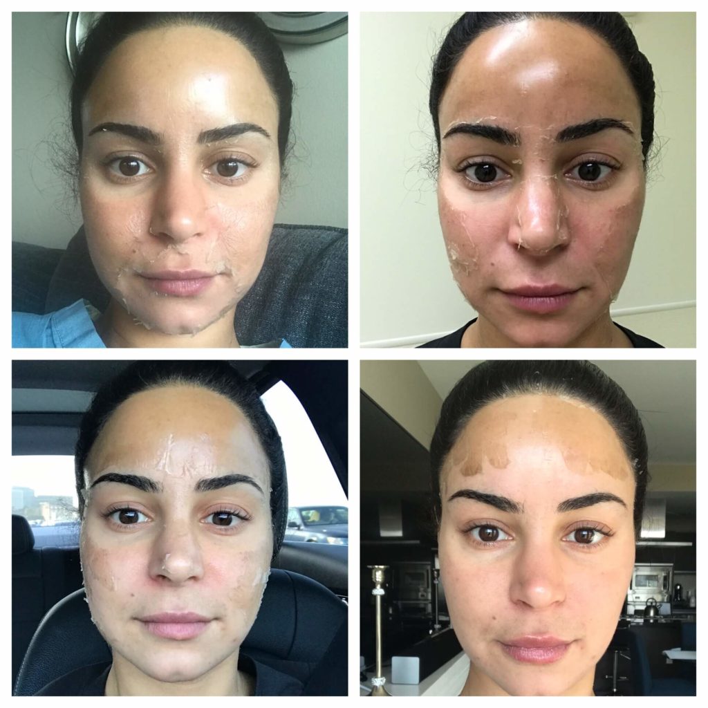 Before and After Three step Peel Treatment | Beauty Boost Med Spa in Newport Beach, CA