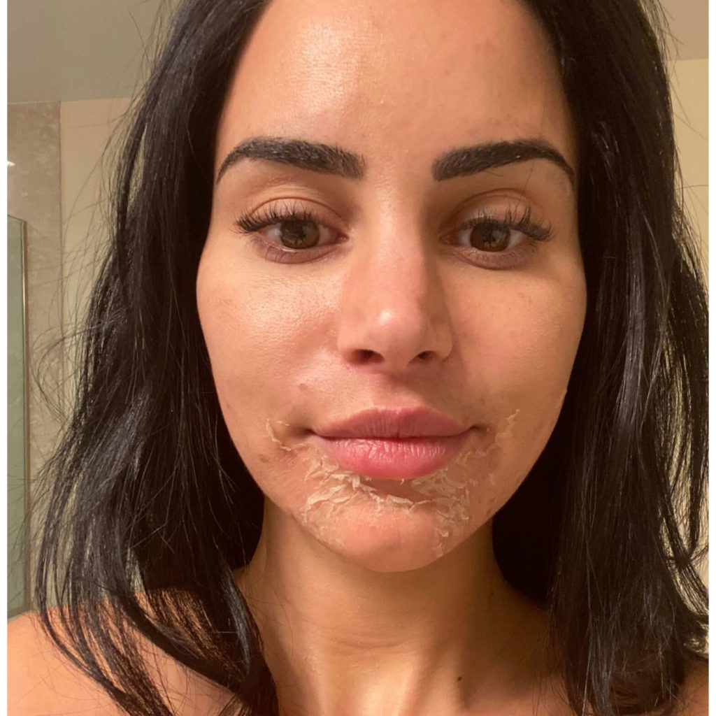 Before and After Three step Peel Treatment | Beauty Boost Med Spa in Newport Beach, CA