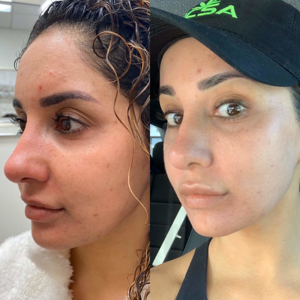 Before and After Three step Peel Treatment | Beauty Boost Med Spa in Newport Beach, CA