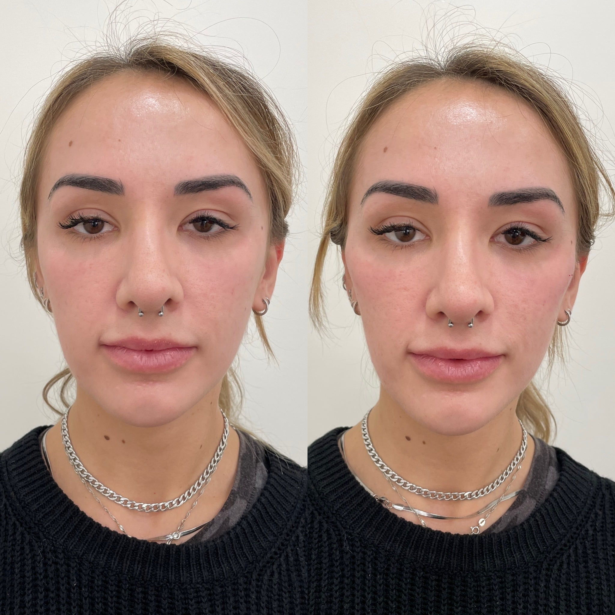 Before and After Cheeks after treatment in Beauty Boost Med Spa at Newport Beach, CA