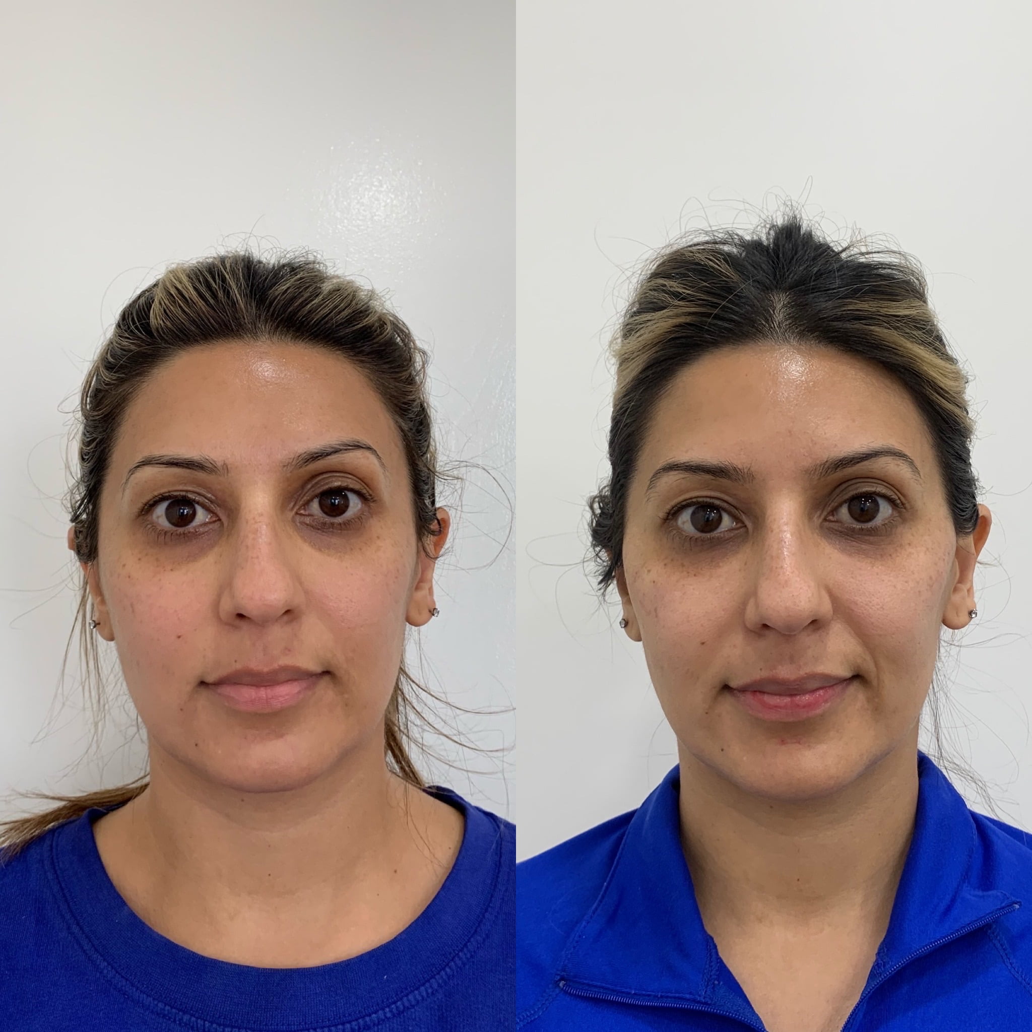 Before and After Cheeks after treatment in Beauty Boost Med Spa at Newport Beach, CA