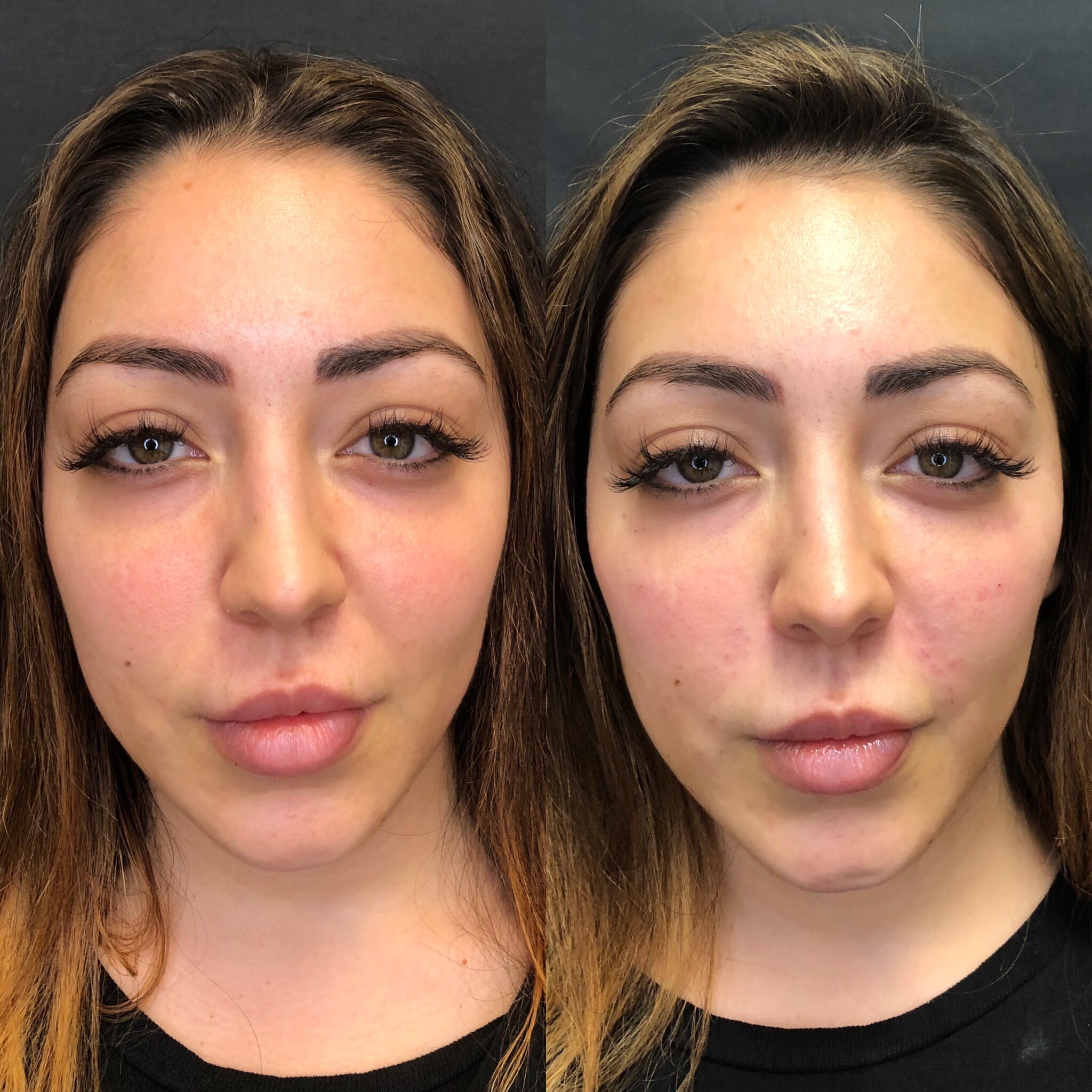 Before and After Cheeks treatment in Beauty Boost Med Spa at Newport Beach, CA