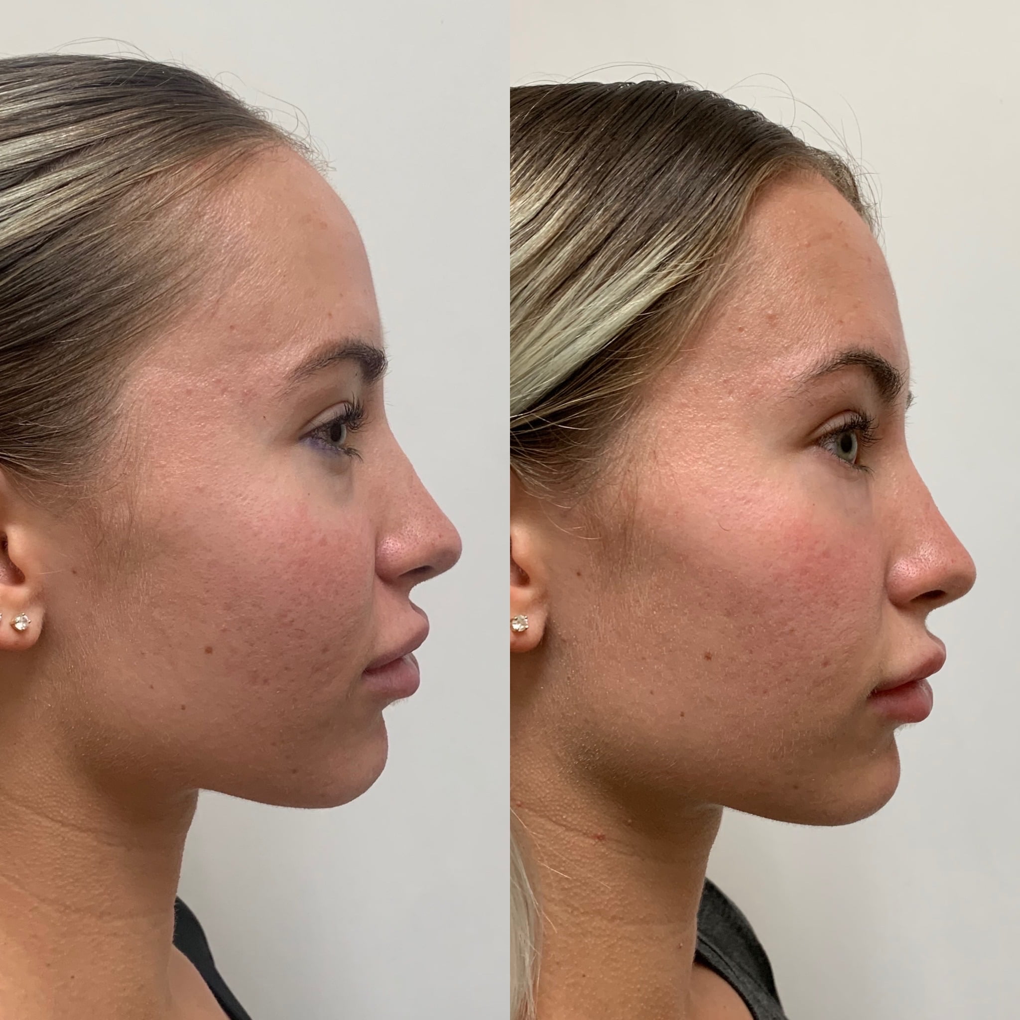 Before and After Cheeks treatment in Beauty Boost Med Spa at Newport Beach, CA
