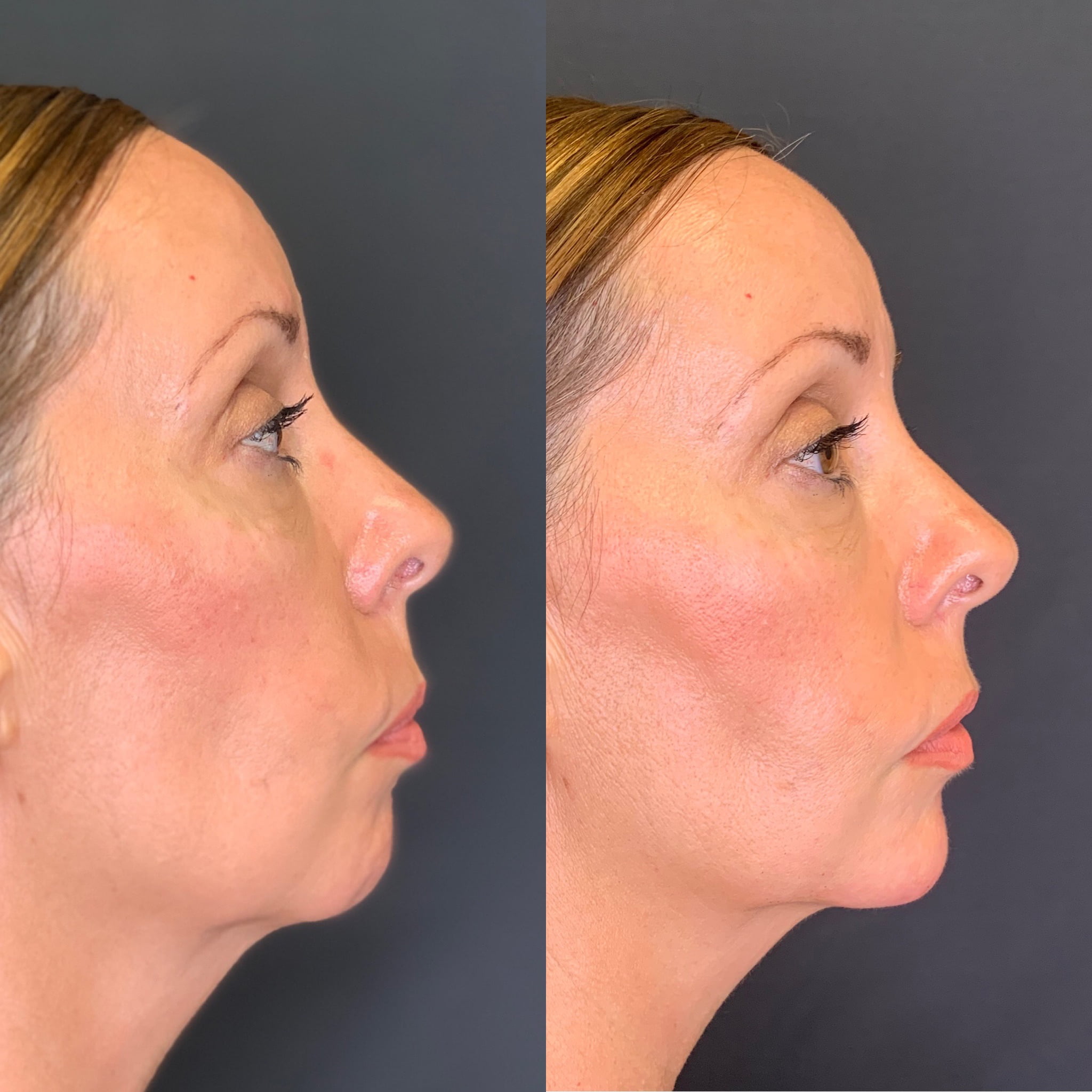 Before and After treatment results on Chin | Beauty Boost Med Spa in Newport Beach, CA