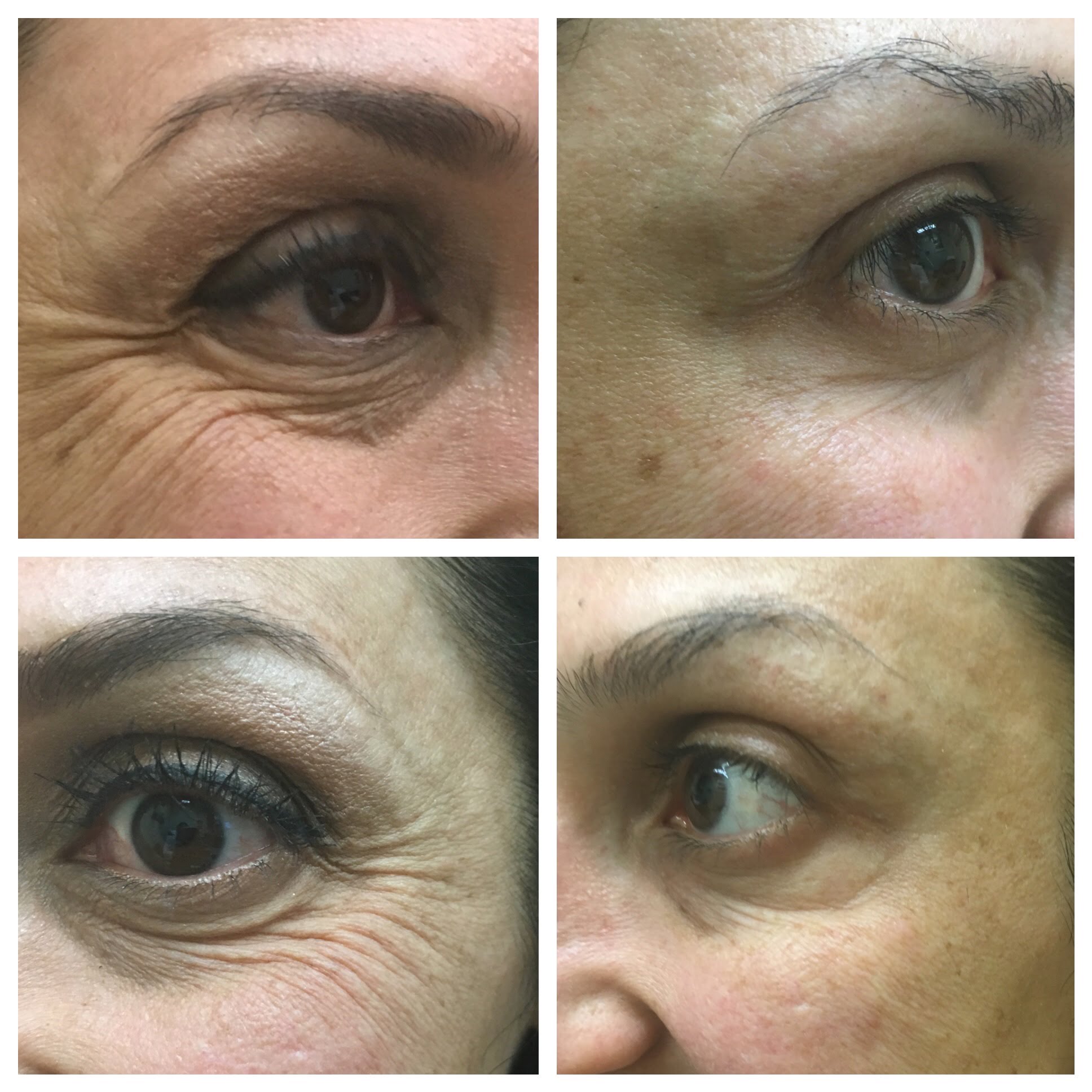 Before and After Botox Crows-BL-Bunny treatment | Beauty Boost Med Spa at Newport Beach, CA