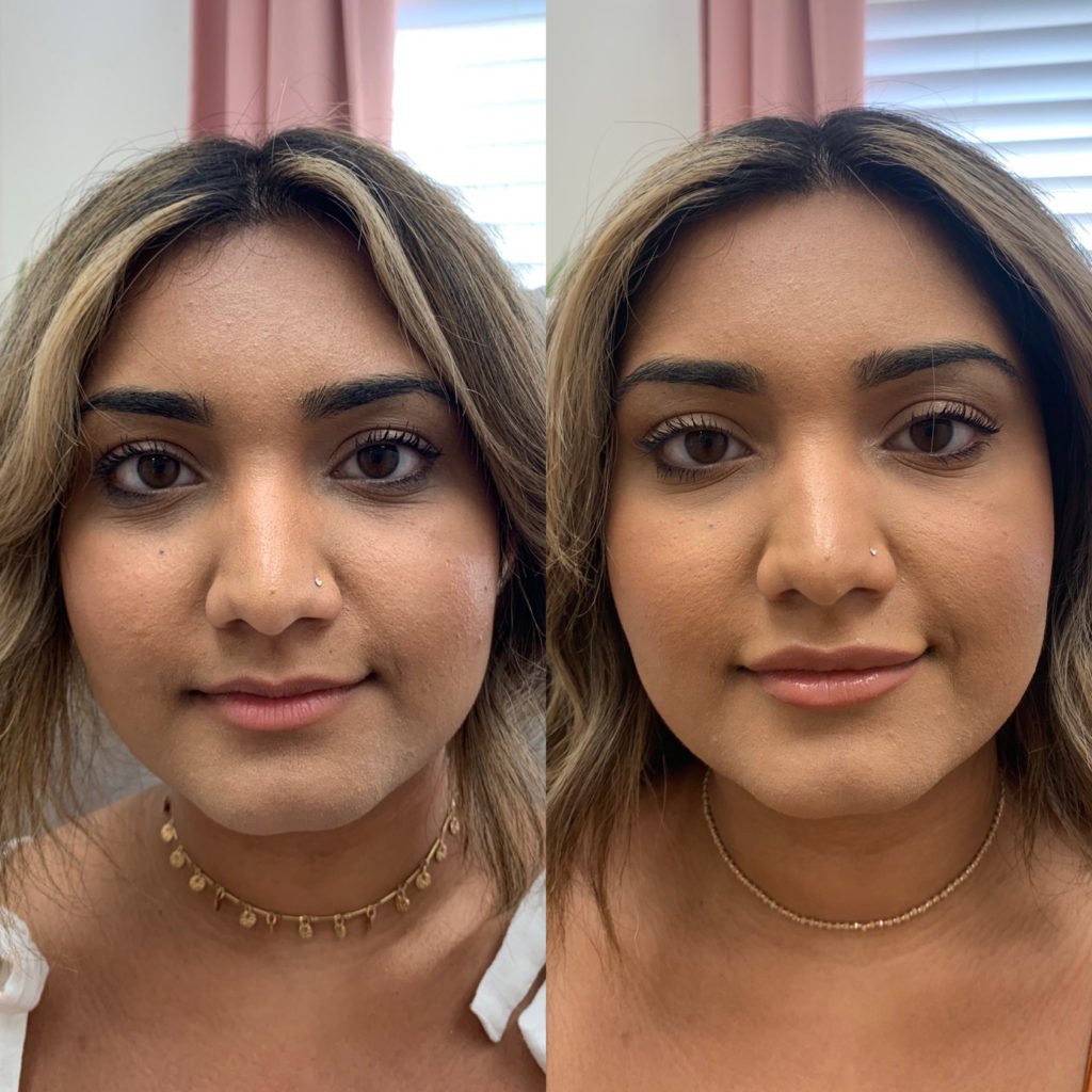 Before and After Botox Crows-BL-Bunny treatment | Beauty Boost Med Spa at Newport Beach, CA