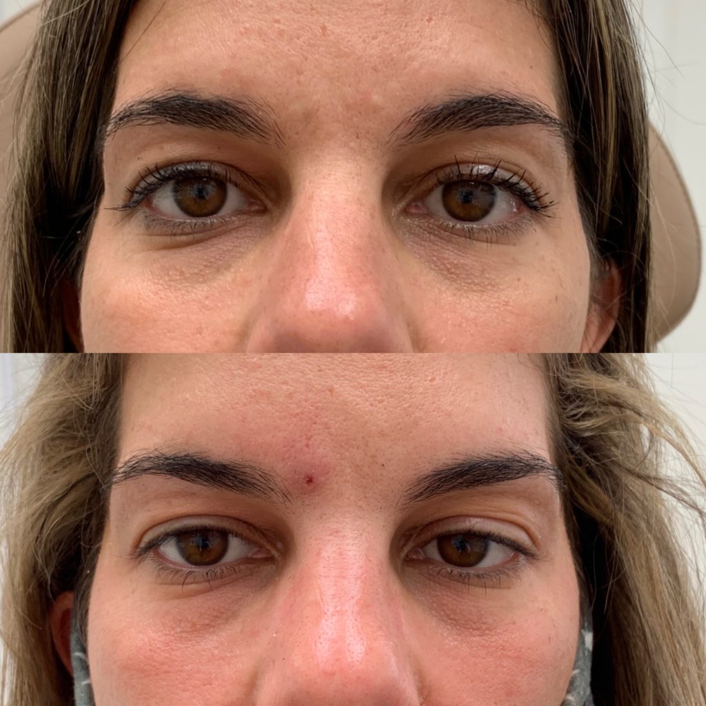 Before and After Botox Crows-BL-Bunny treatment | Beauty Boost Med Spa at Newport Beach, CA