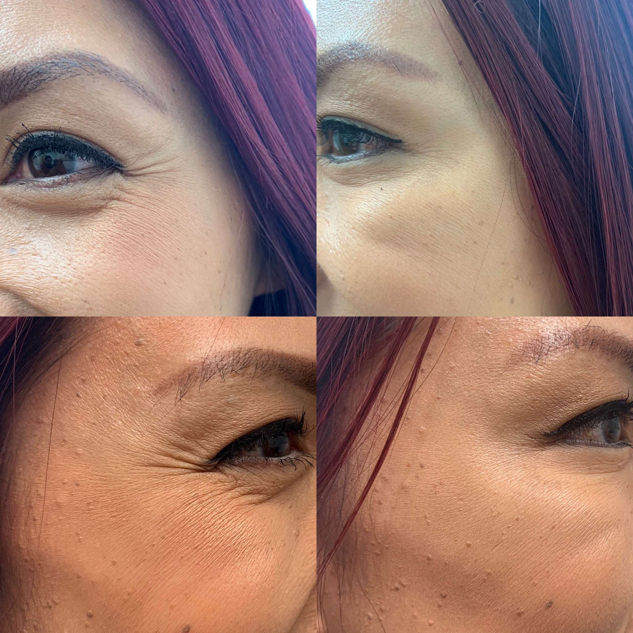 Before and After Botox Crows BL Bunny treatment | Beauty Boost Med Spa in Newport Beach, CA