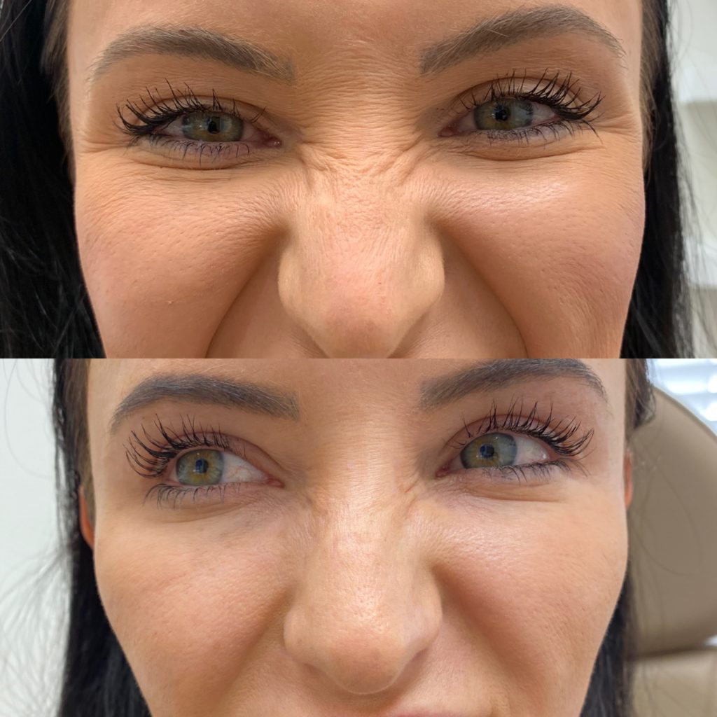 Before and After Botox Crows-BL-Bunny treatment | Beauty Boost Med Spa at Newport Beach, CA