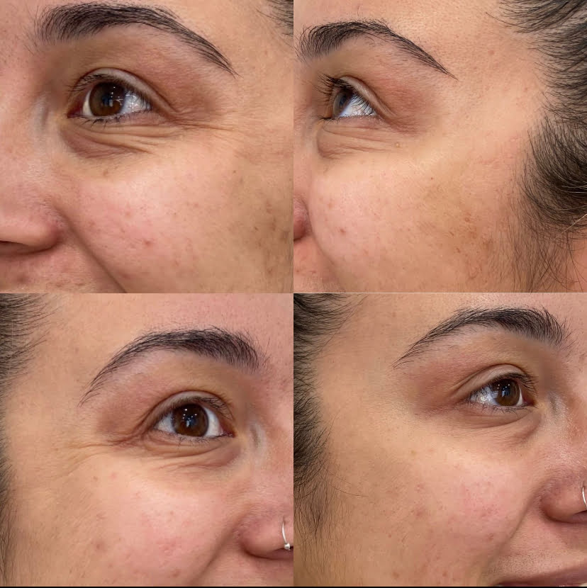 Before and After Botox Crows-BL-Bunny treatment | Beauty Boost Med Spa at Newport Beach, CA