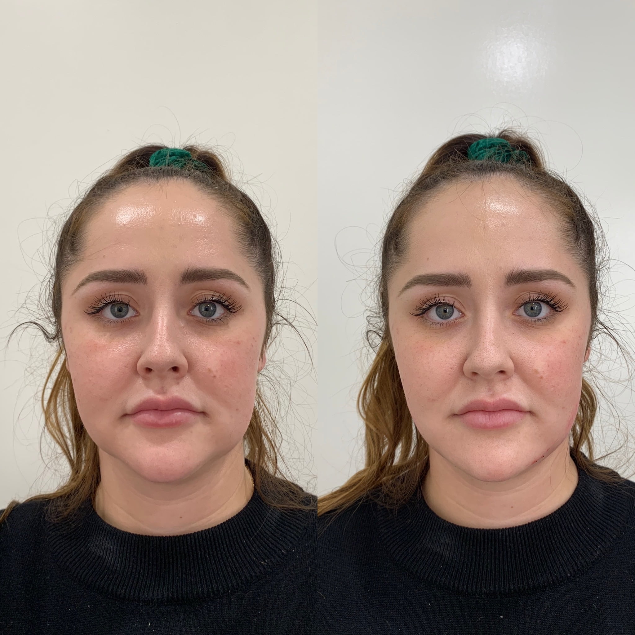 Before and After Fillers Jawline Treatment | Beauty Boost Med Spa in Newport Beach, CA
