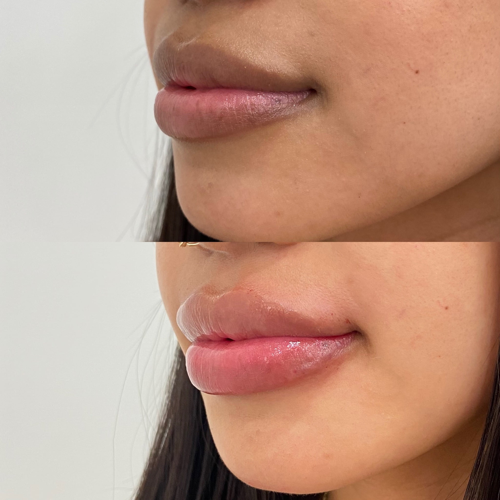Before and After Lip boost Treatment | Beauty Boost Med Spa in Newport Beach, CA