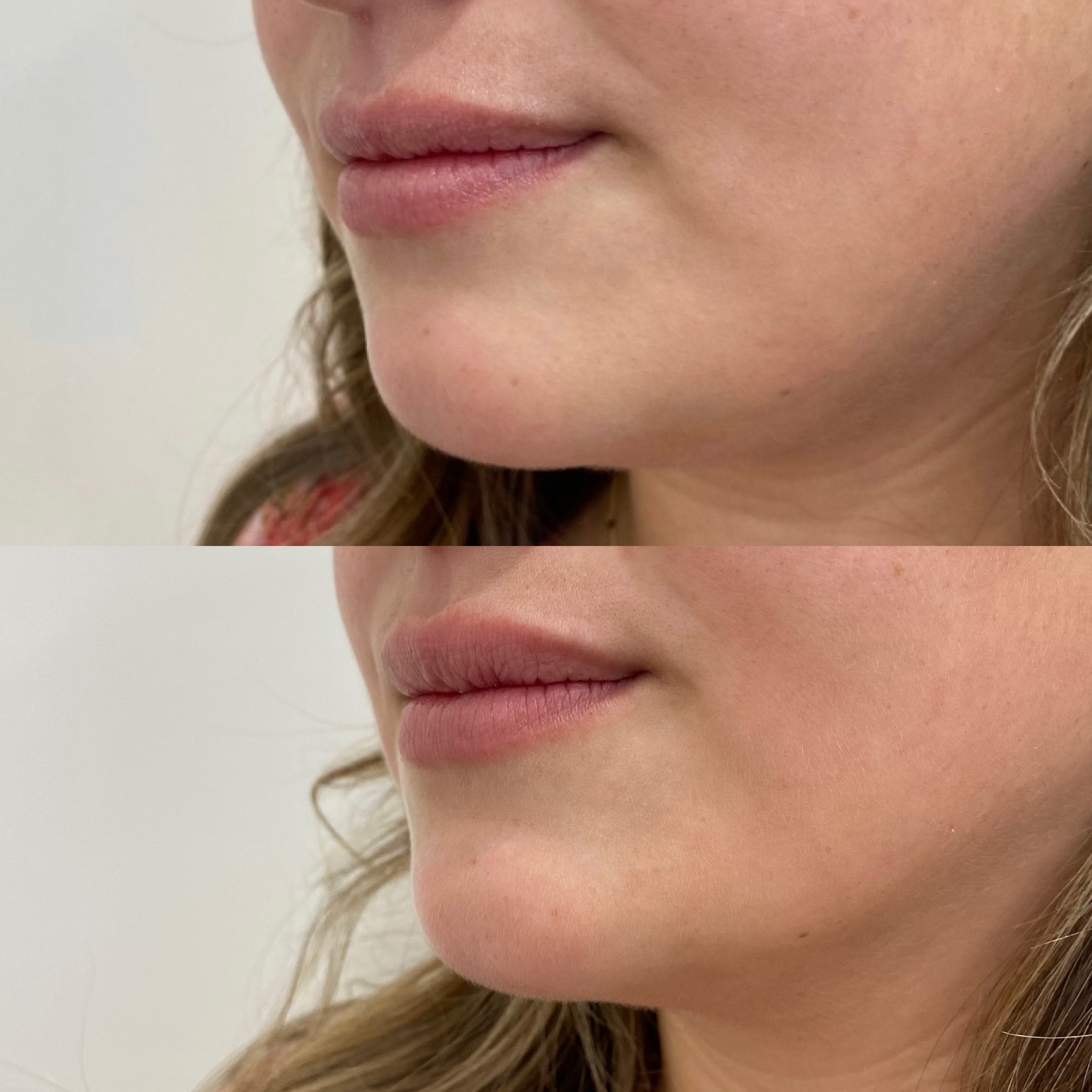 Before and After Lip lines Treatment | Beauty Boost Med Spa in Newport Beach, CA