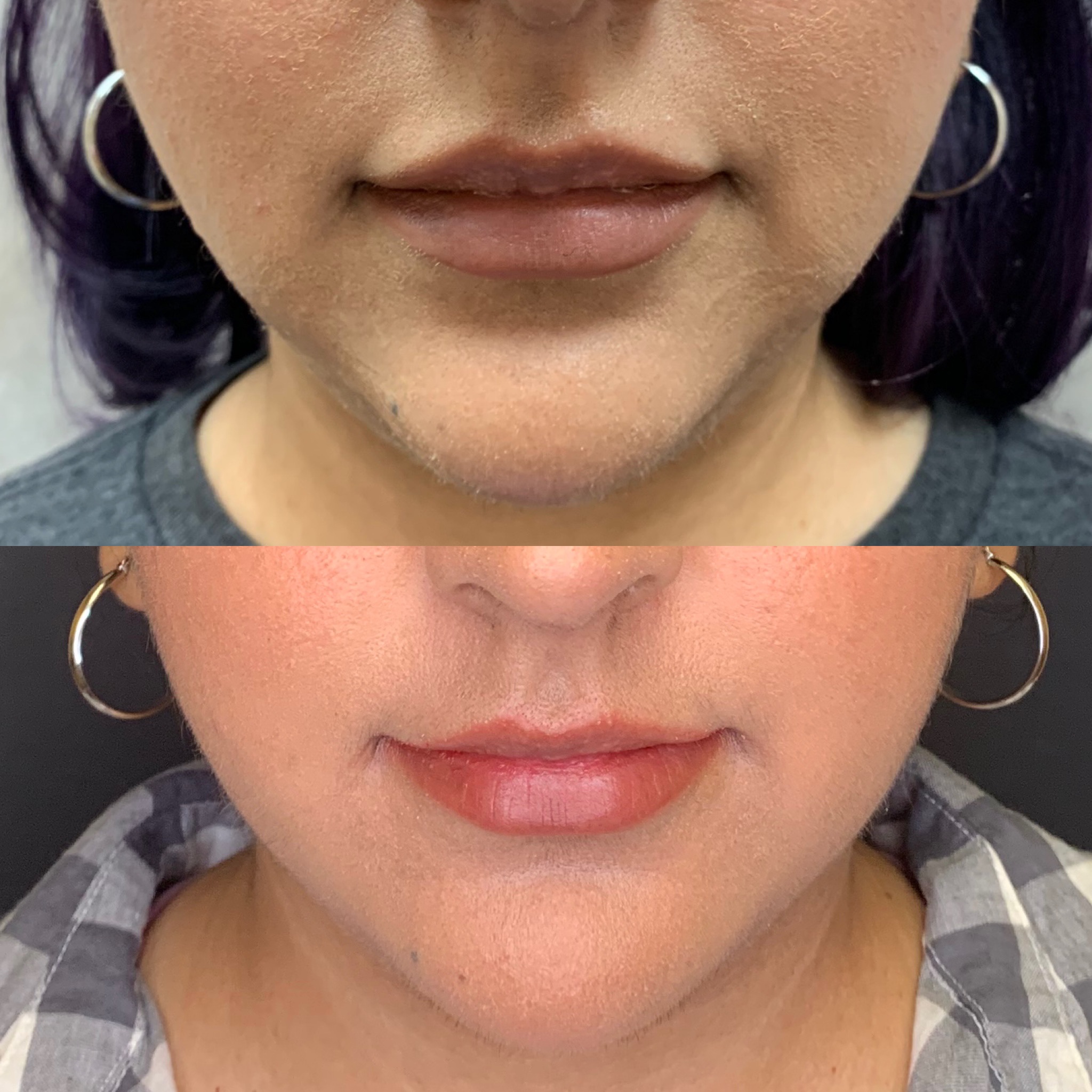 Before and After Marionettes Treatment | Beauty Boost Med Spa in Newport Beach, CA