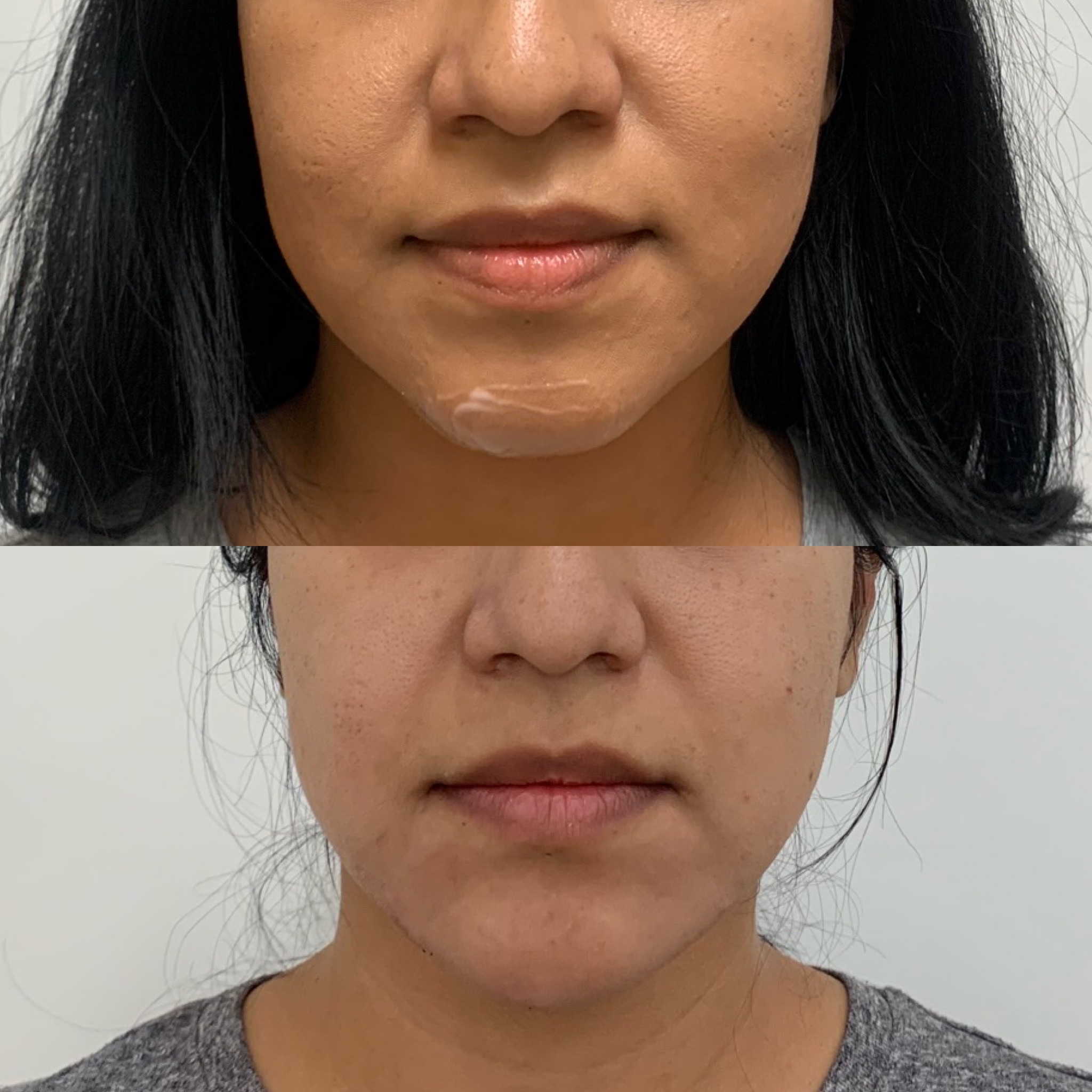 Before and After Marionettes Treatment | Beauty Boost Med Spa in Newport Beach, CA