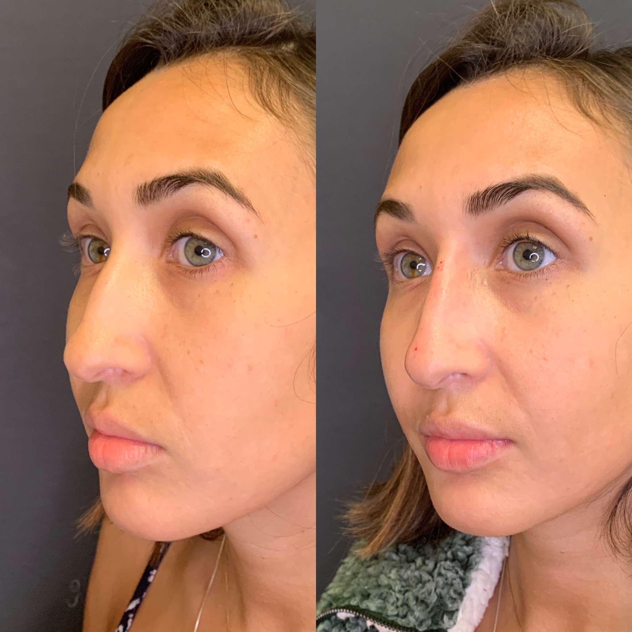Before and After Treatment on Nose | Beauty Boost Med Spa in Newport Beach, CA