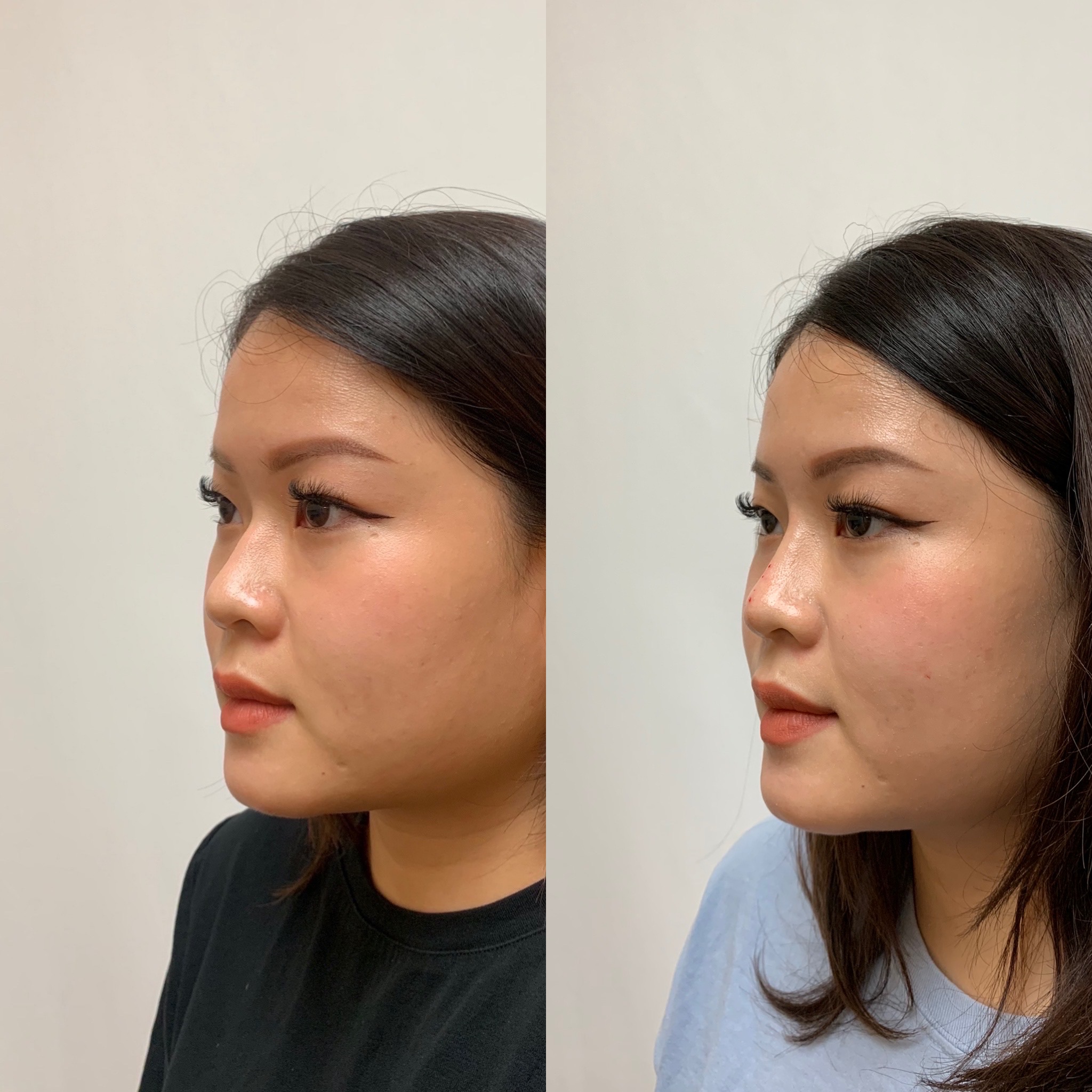 Before and After Treatment on Nose | Beauty Boost Med Spa in Newport Beach, CA