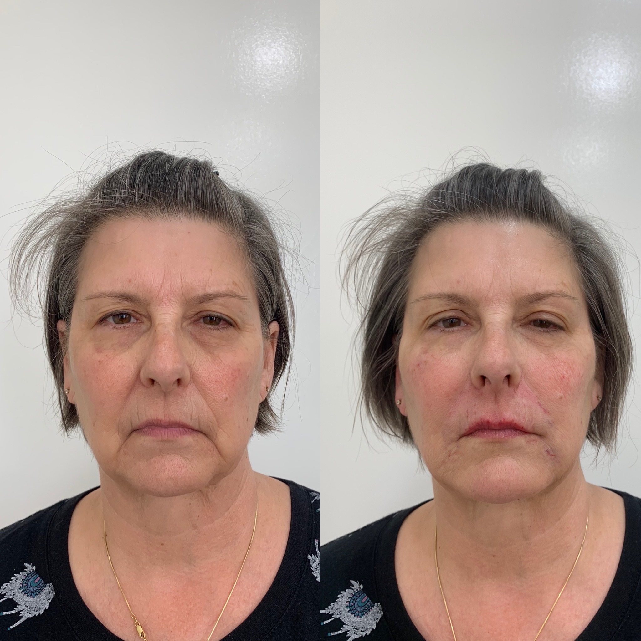 Before and After Panfacial Treatment | Beauty Boost Med Spa in Newport Beach, CA