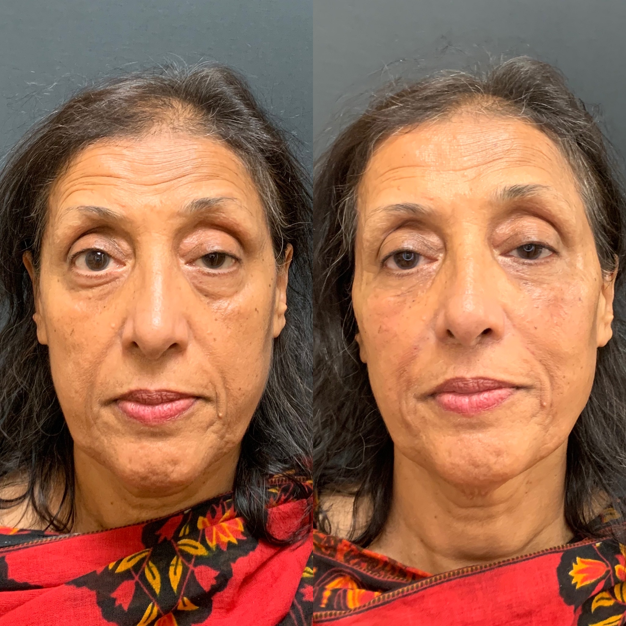 Before and After Panfacial Treatment | Beauty Boost Med Spa in Newport Beach, CA