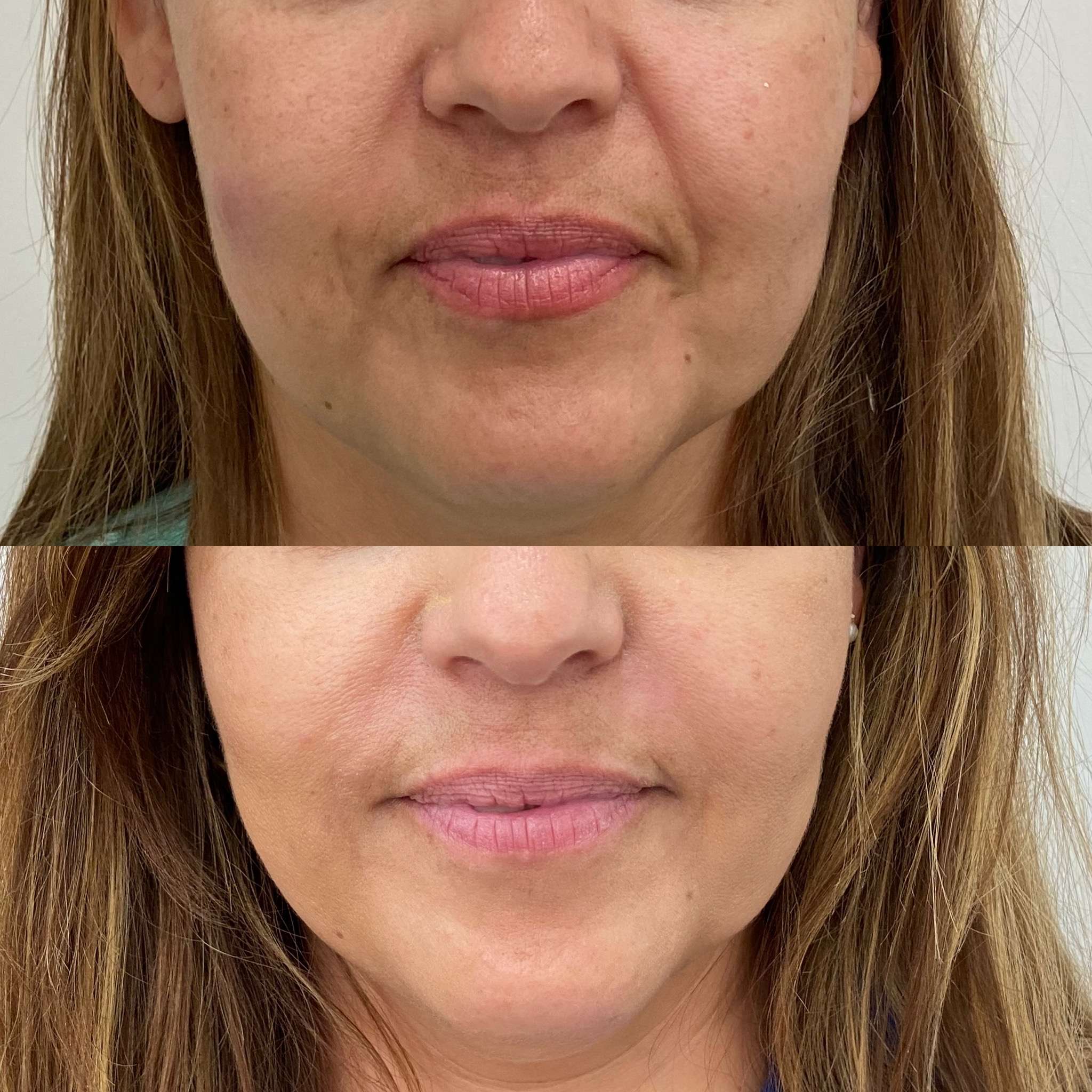 Before and After Smile Lines Treatment | Beauty Boost Med Spa in Newport Beach, CA
