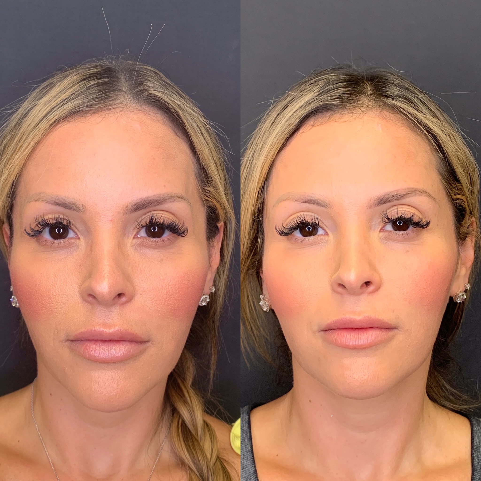 Before and After Temple Fillers Treatment | Beauty Boost Med Spa in Newport Beach, CA
