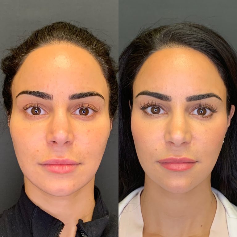 Dermal Fillers Before And After See Why We Love Fillers