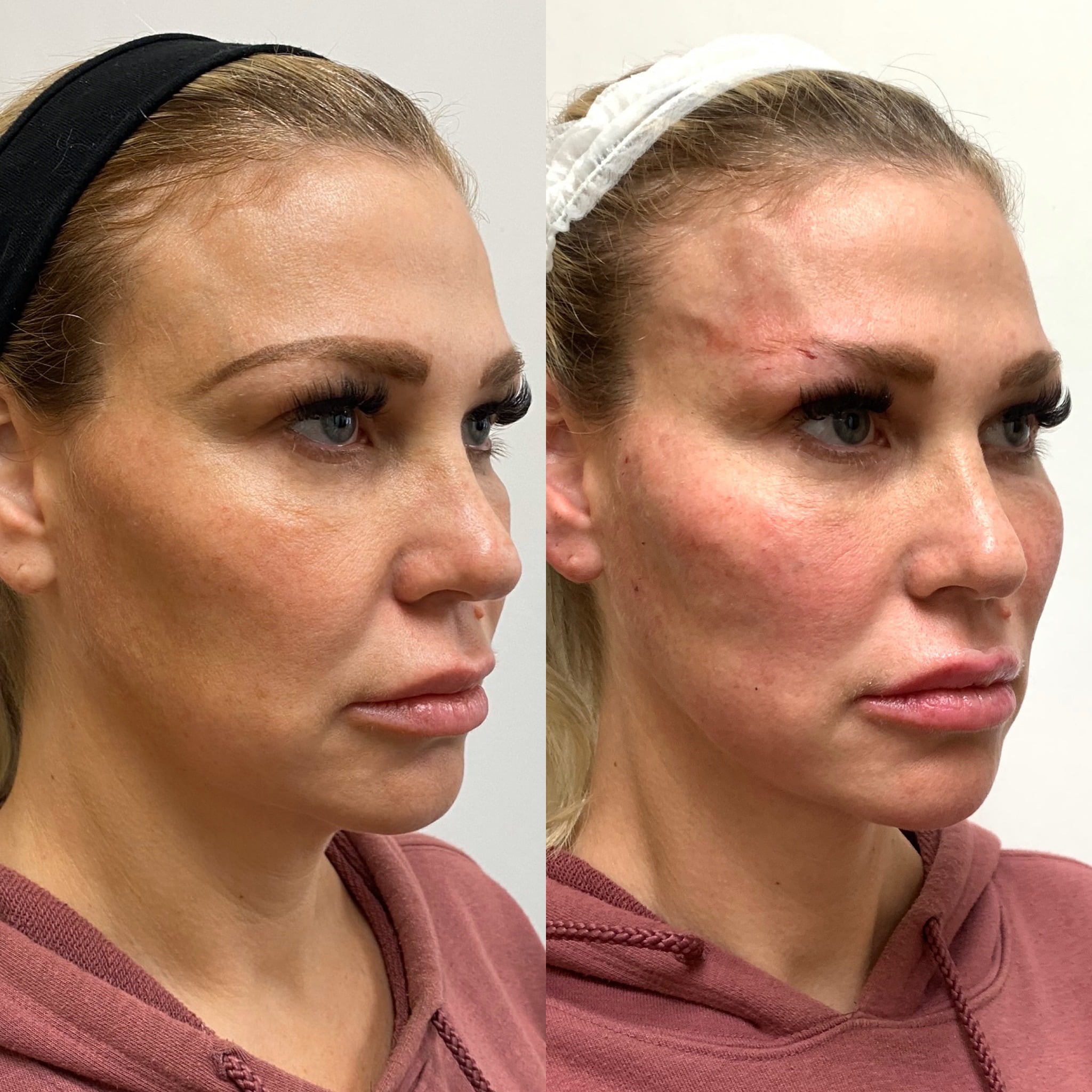 Pdo Threads Before And After Images Medspa In Newport Beach