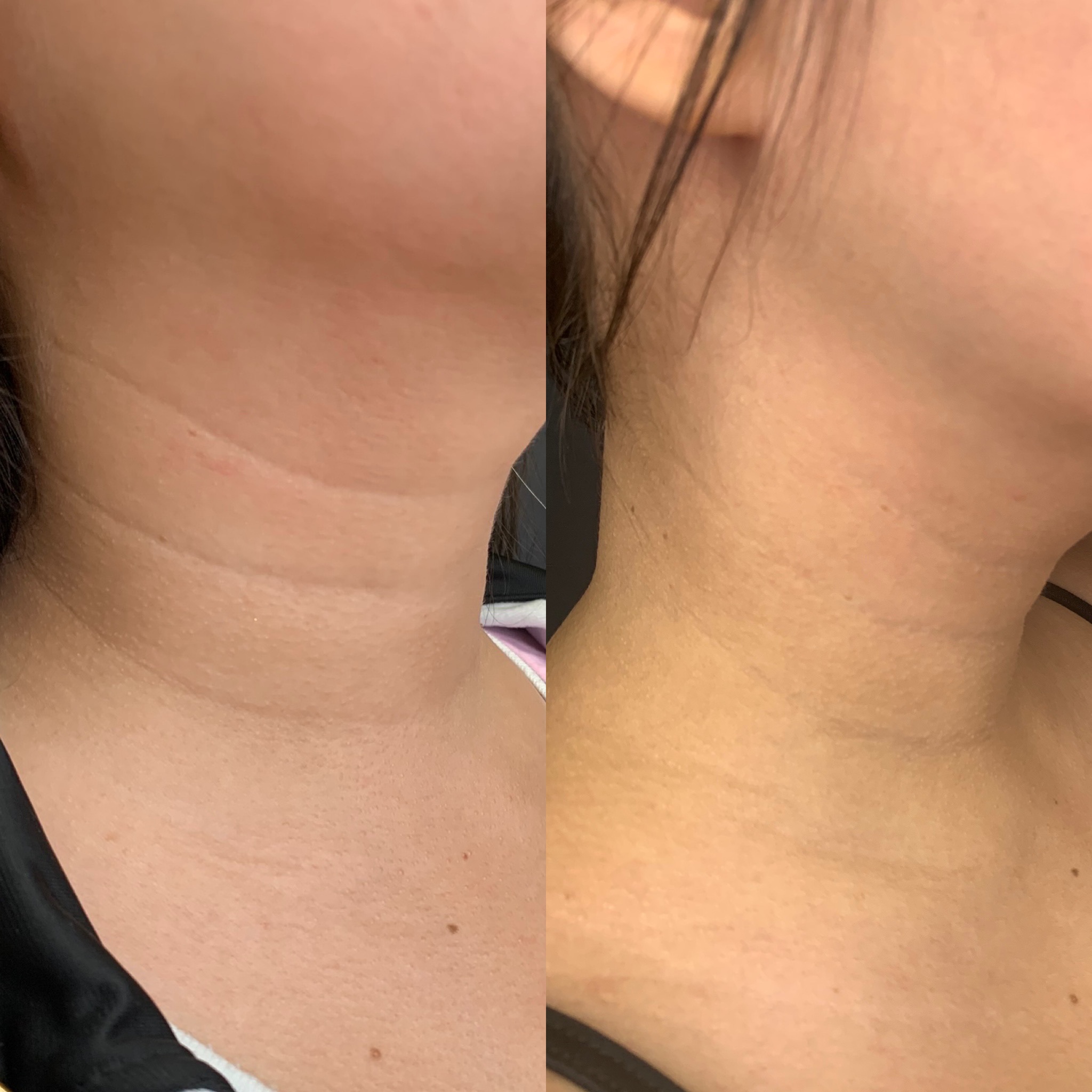 Before and After Fillers Treatment on Neck | Beauty Boost Med Spa in Newport Beach, CA