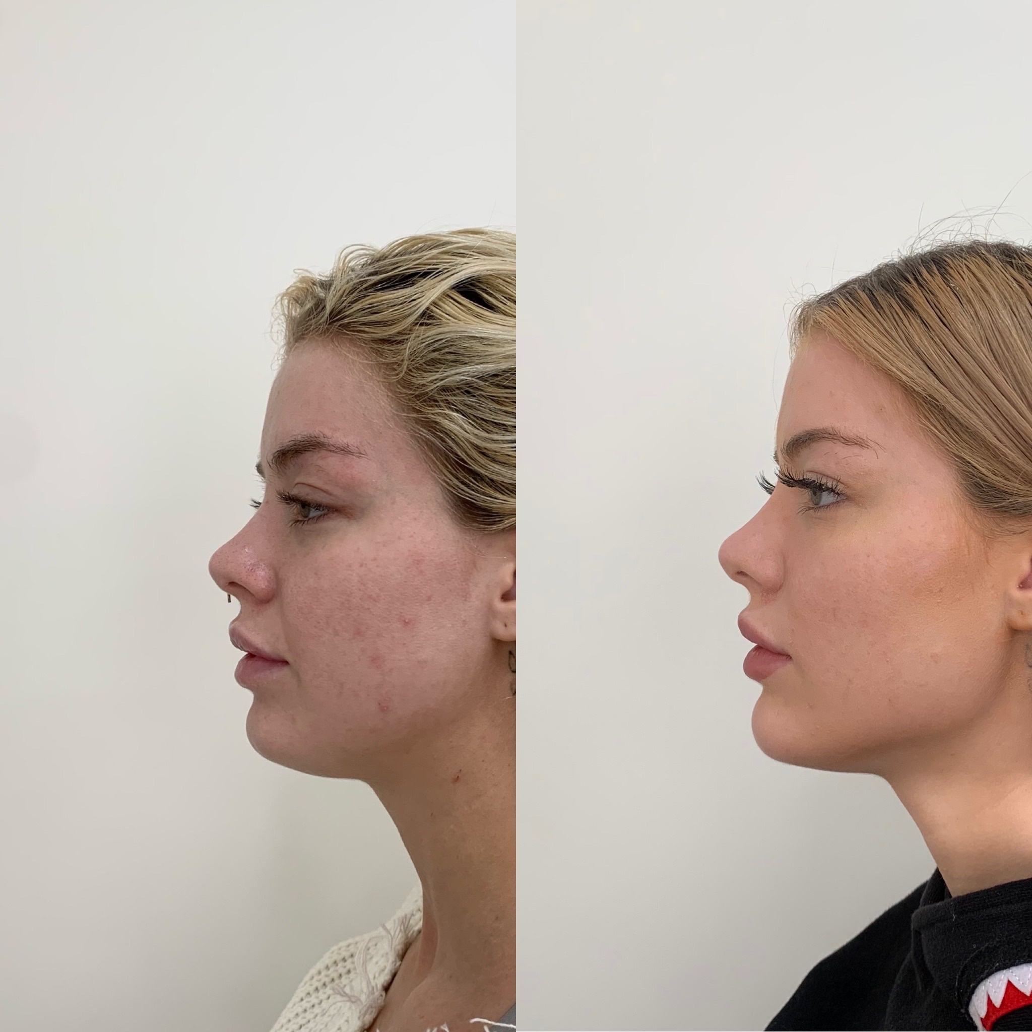 Before and After Fillers Treatment | Beauty Boost Med Spa in Newport Beach, CA