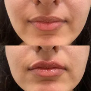 Lip Filler Las Vegas