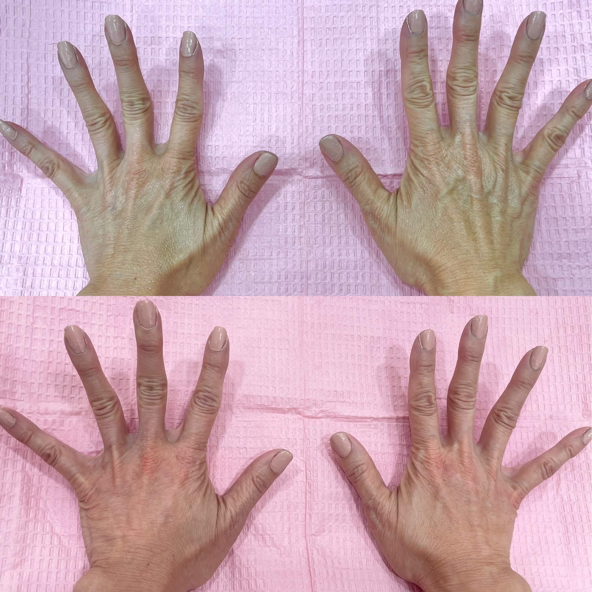 Before and After Fillers Treatment on Hands | Beauty Boost Med Spa in Newport Beach, CA
